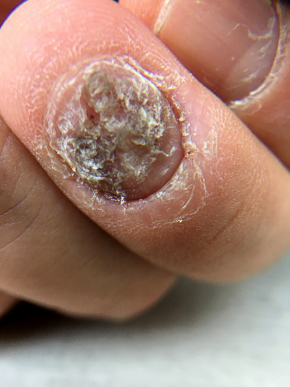 手上鸡眼怎么治好?  在我的诊所里,最近接待了一位名叫张先生的患者.