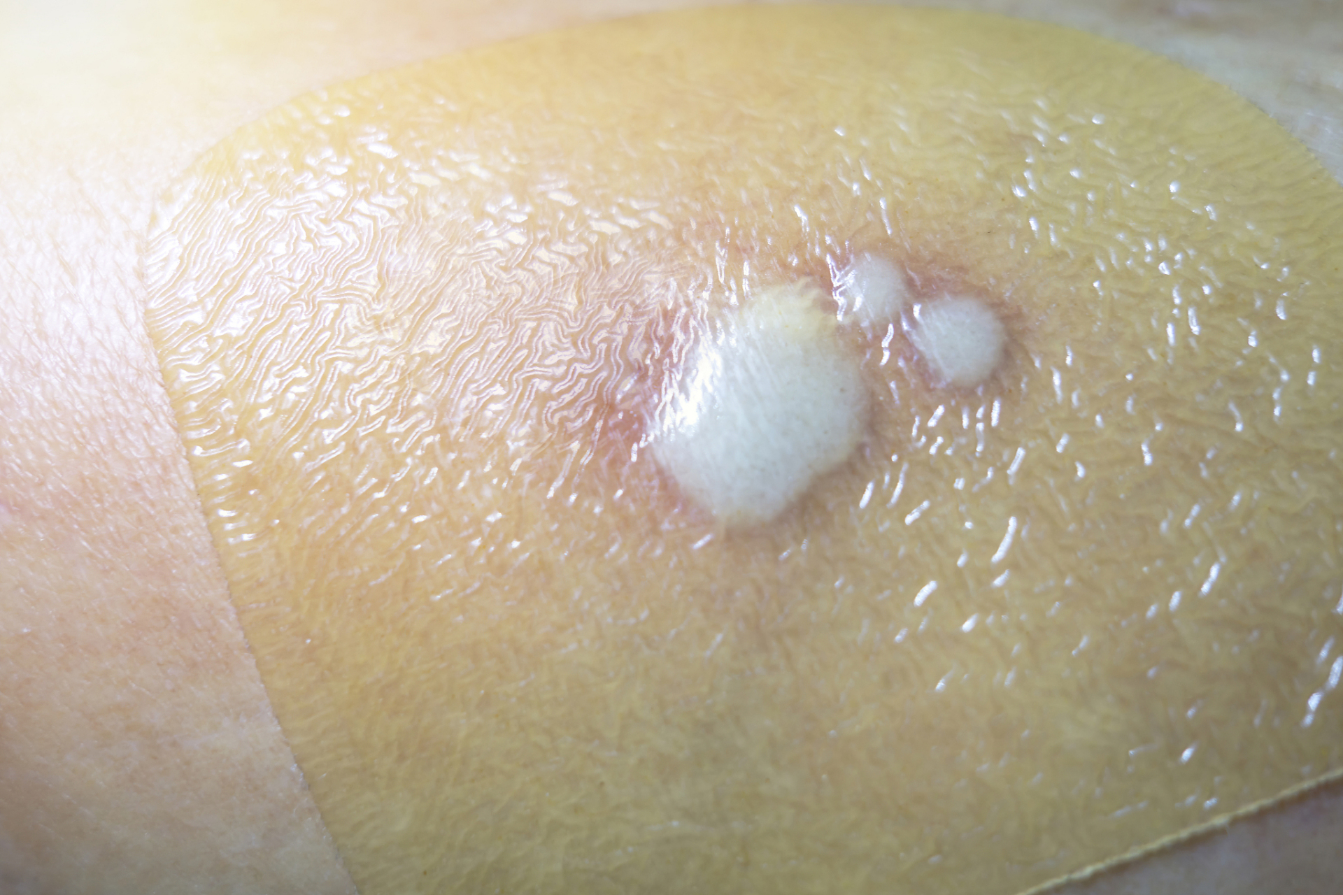 1,火疖子是一种化脓性毛囊及毛囊深部周围组织的感染,表现为局部