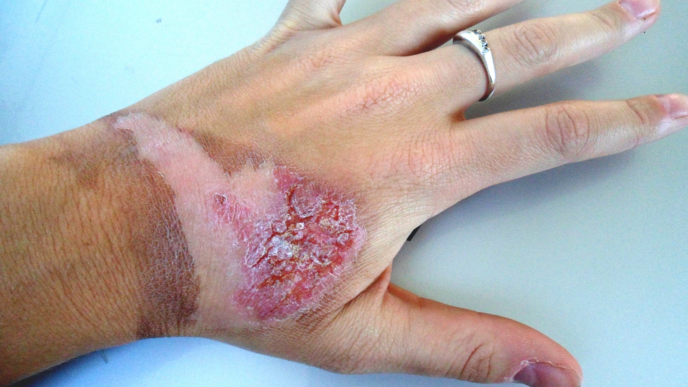 电烧伤疤痕,是许多患者心中的痛.我深知疤痕对患者心理和生活的影响.