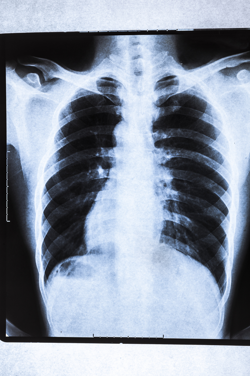 性咳嗽人群,其次是长期吸烟的人群;    第二就是有慢性肺部疾病或者是