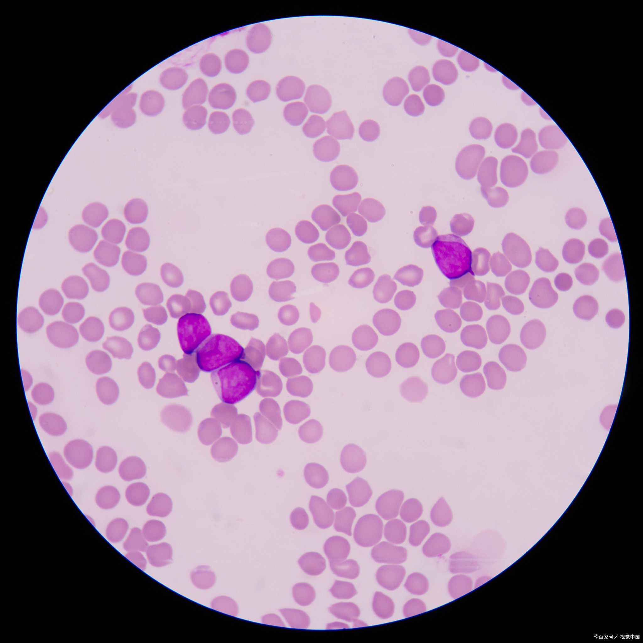 是一种骨髓造血功能衰竭性疾病,其主要表现为全血细胞减少