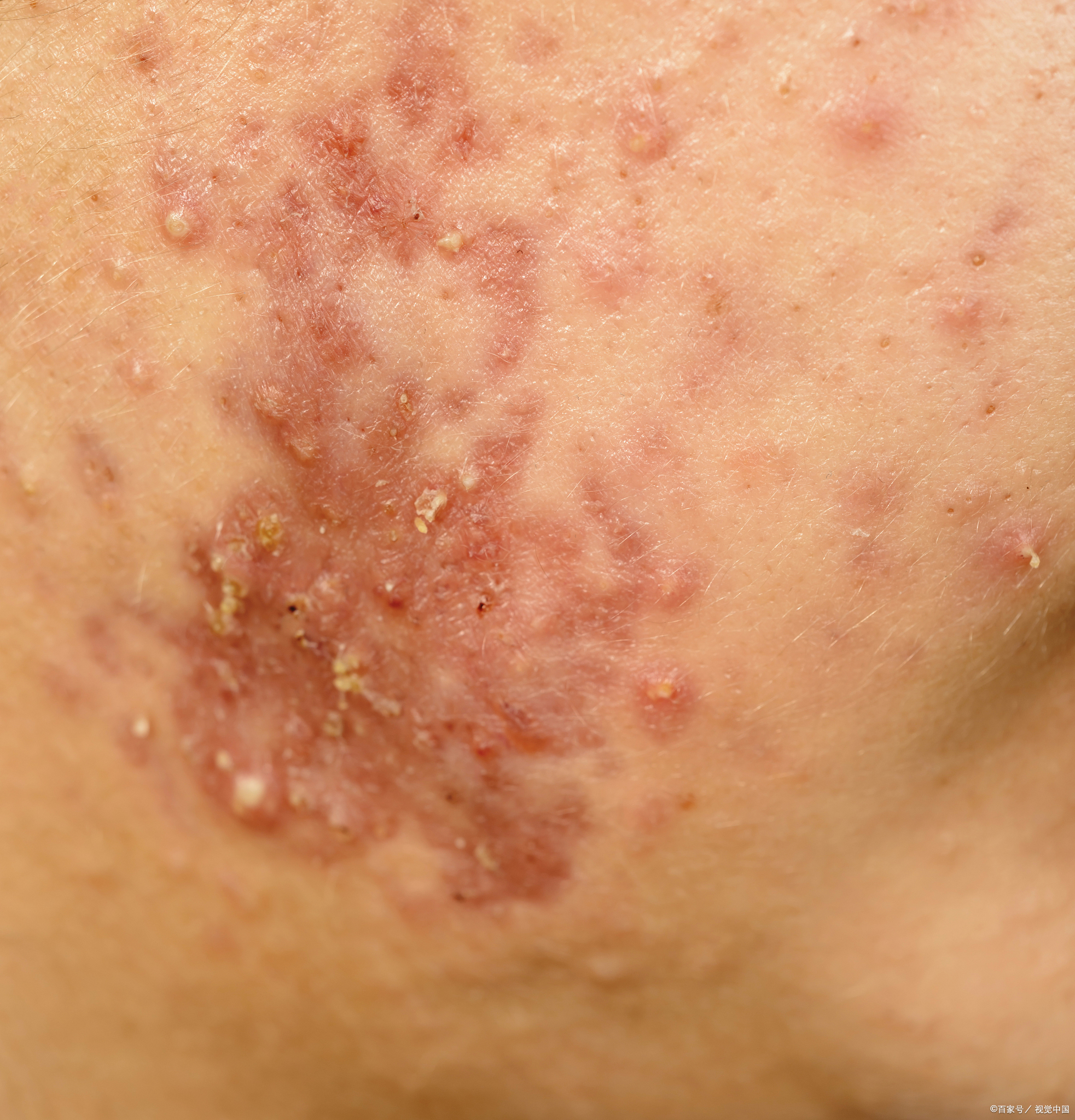 红肿硬痛的痘是哪种?一篇分清 6 种痘痘,新手也能看懂