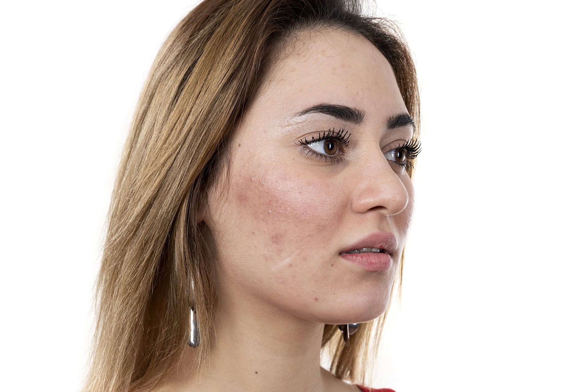 脸上法令纹很深怎么办 脸上法令纹很深,可以采用以下方法解决: 115