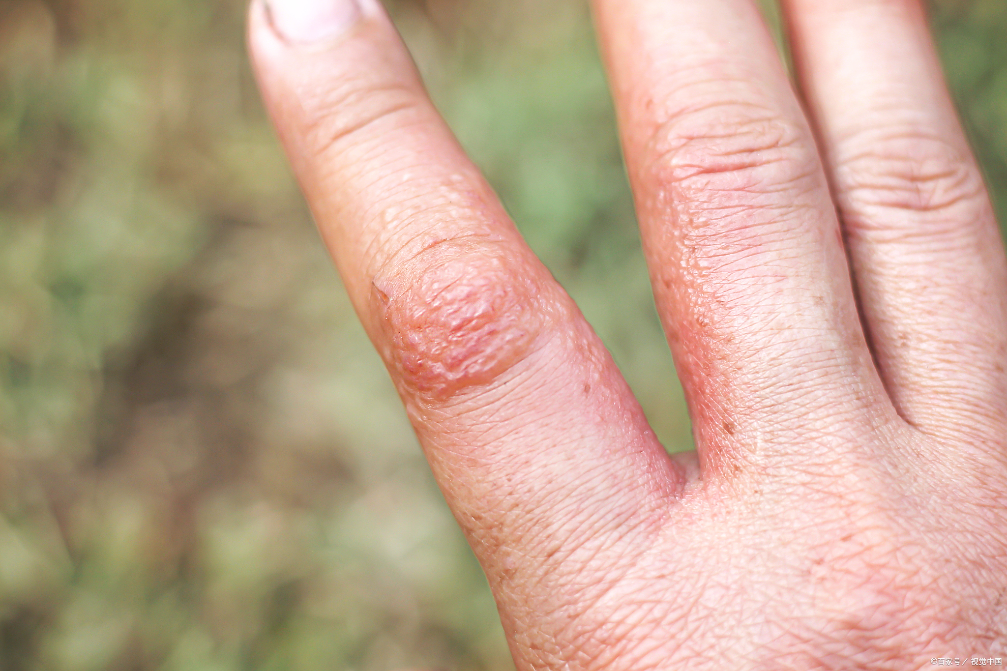 每到夏日,手指,手掌频繁冒出又痒又痛的小水泡,干后脱皮皲裂,可能是汗