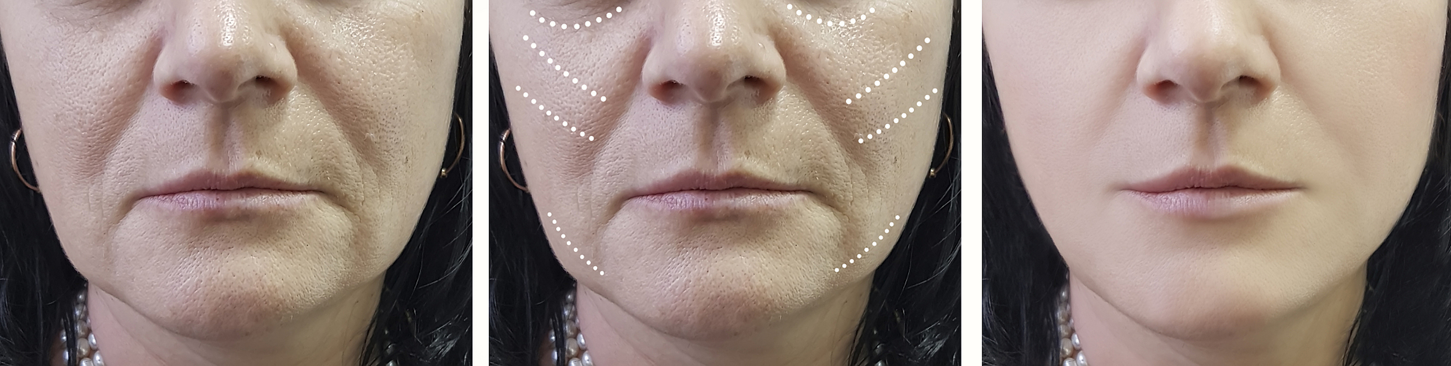 医美#  鼻基底凹陷是一种常见的美容问题,它会使得鼻子看起来不够