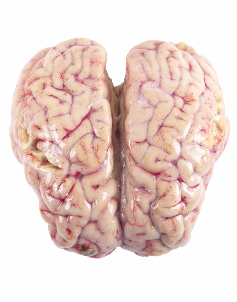 线粒体脑肌病:治愈之路虽长,但希望犹存 98线粒体脑肌病,听起来颇为