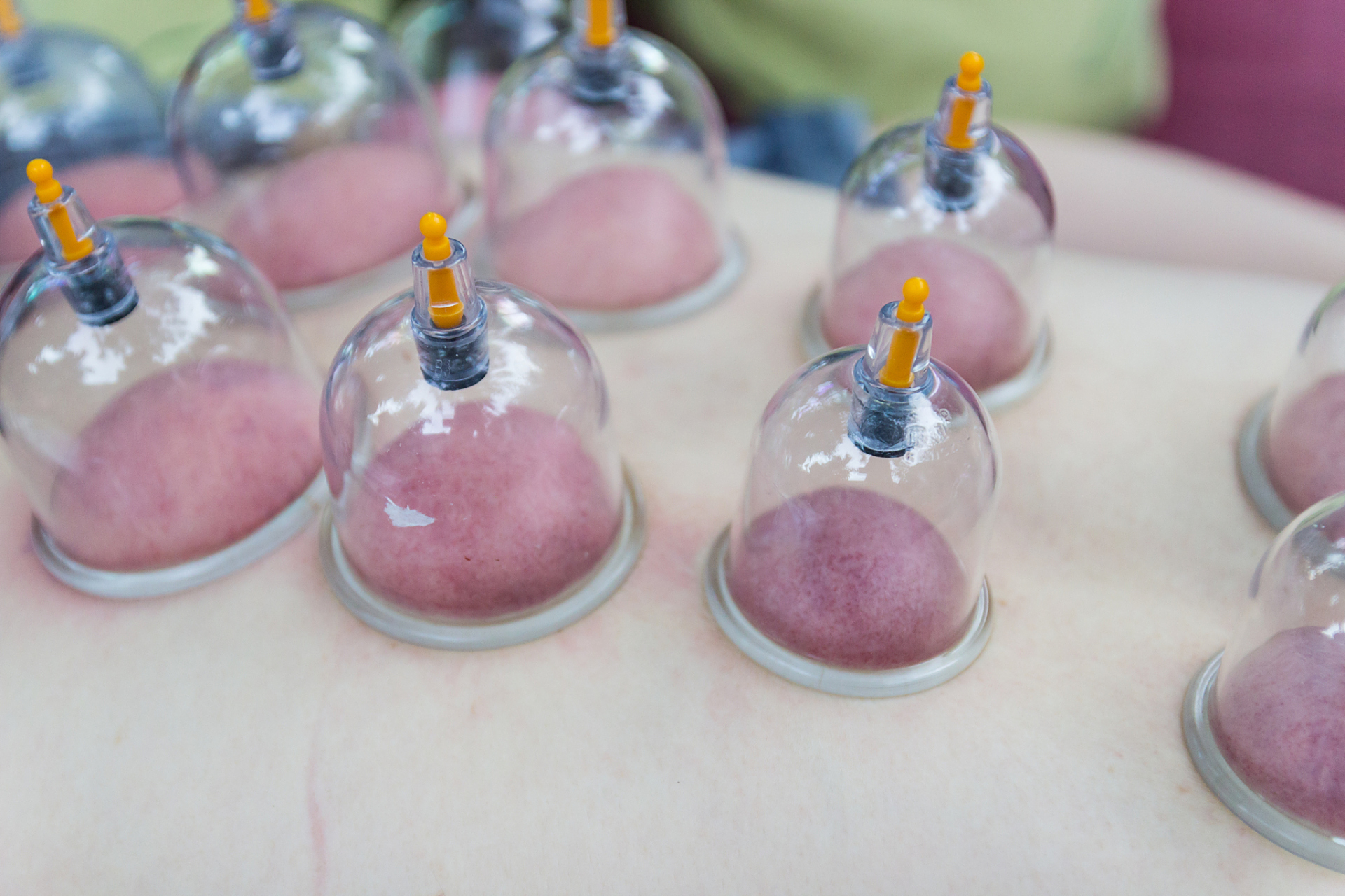 伊朗队以拔罐疗法力克日本队,笑傲赛场,让人瞠目结舌