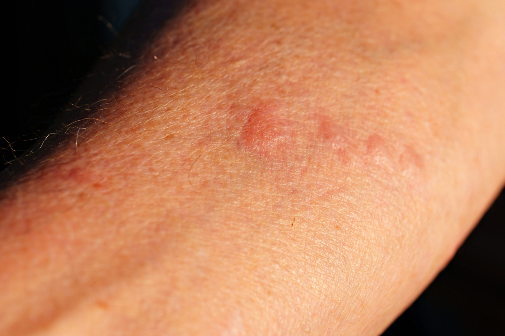 梅毒一比六十四治疗多久?