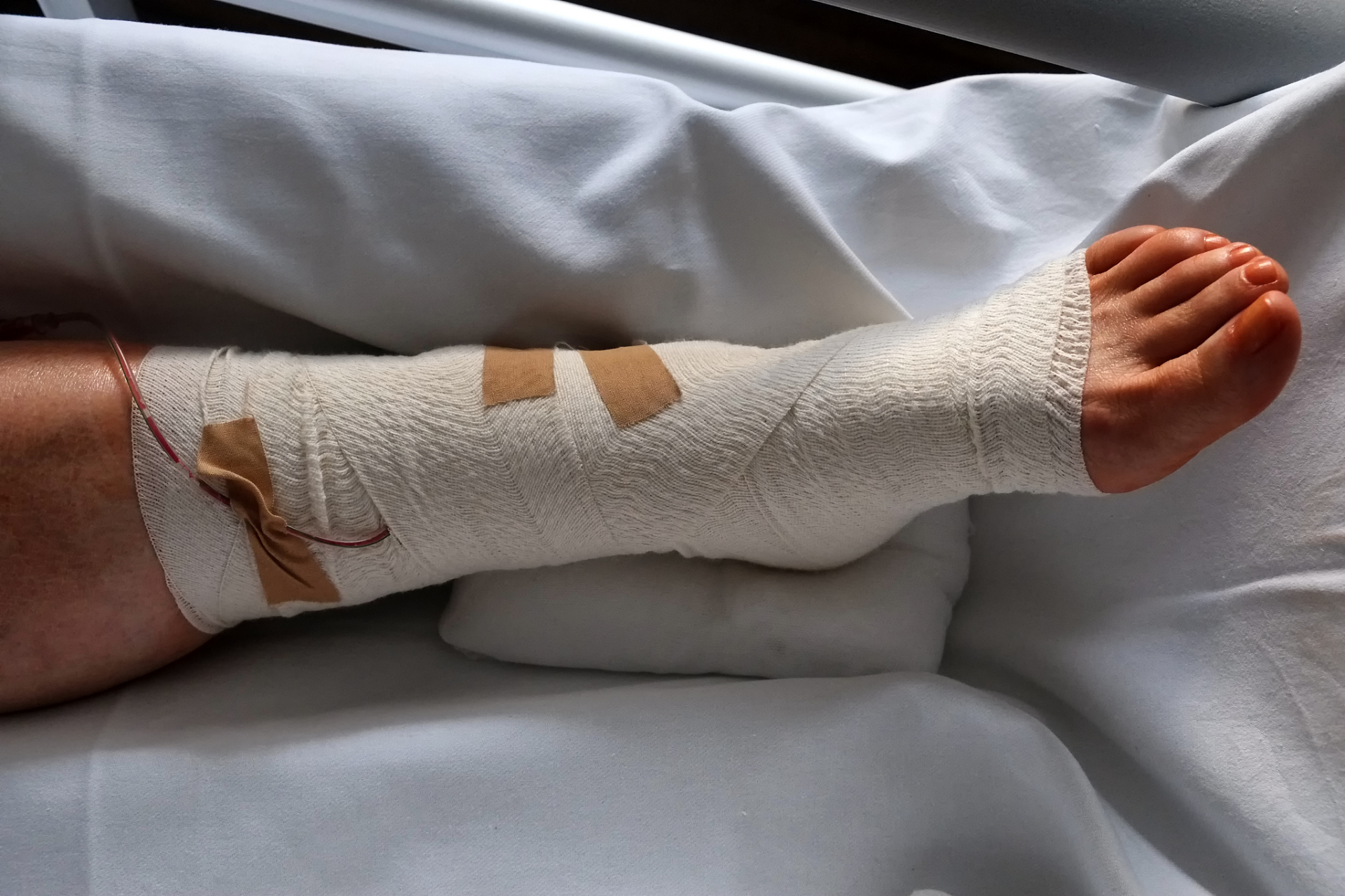 紧急处理与康复指南  小腿骨折,又称为胫腓骨骨折,是常见的下肢损伤.