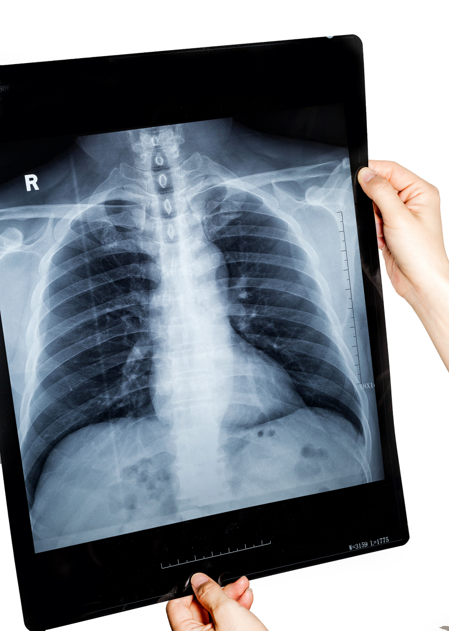 半年前肺部ct正常,半年后会得肺癌吗?