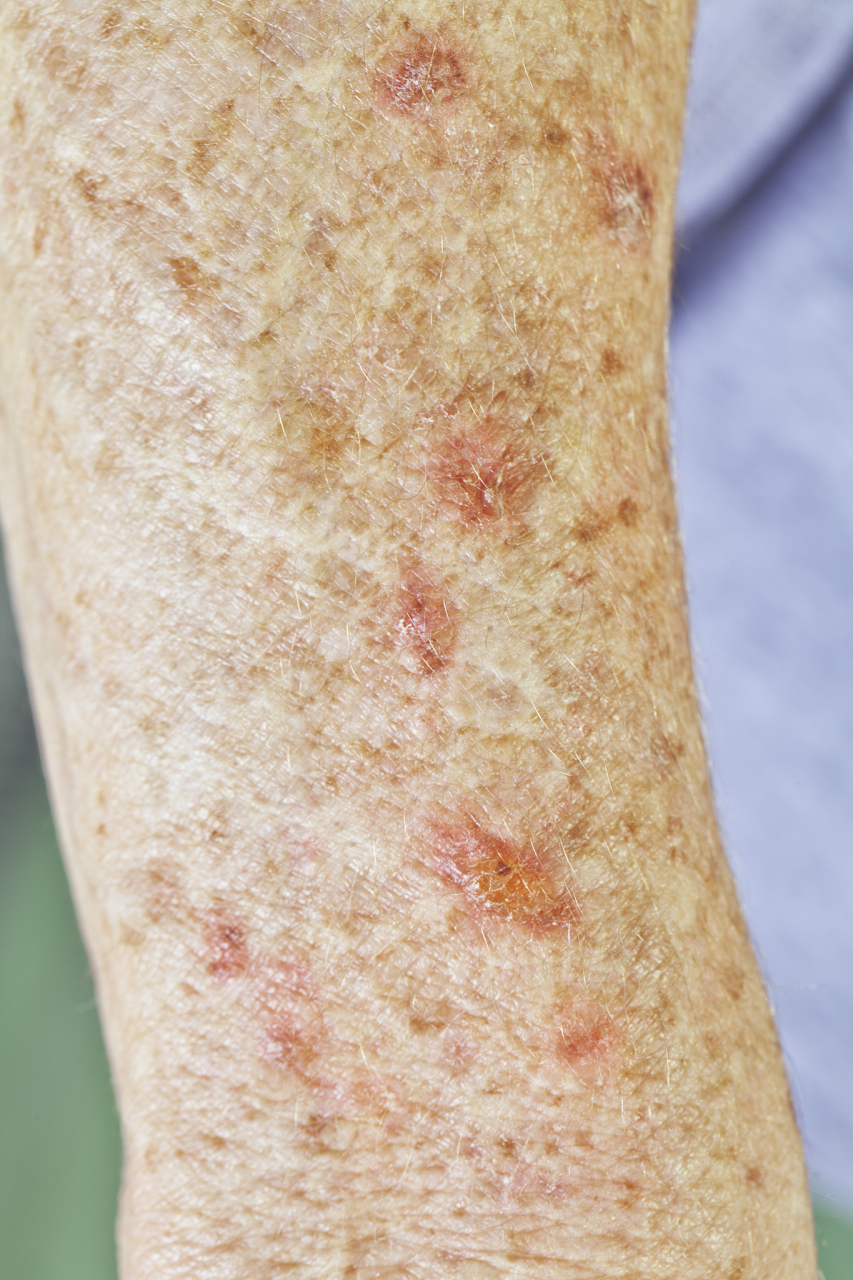 玫瑰糠疹在出现明显的症状前 通常会有以下的前兆: 皮肤敏感:皮肤会