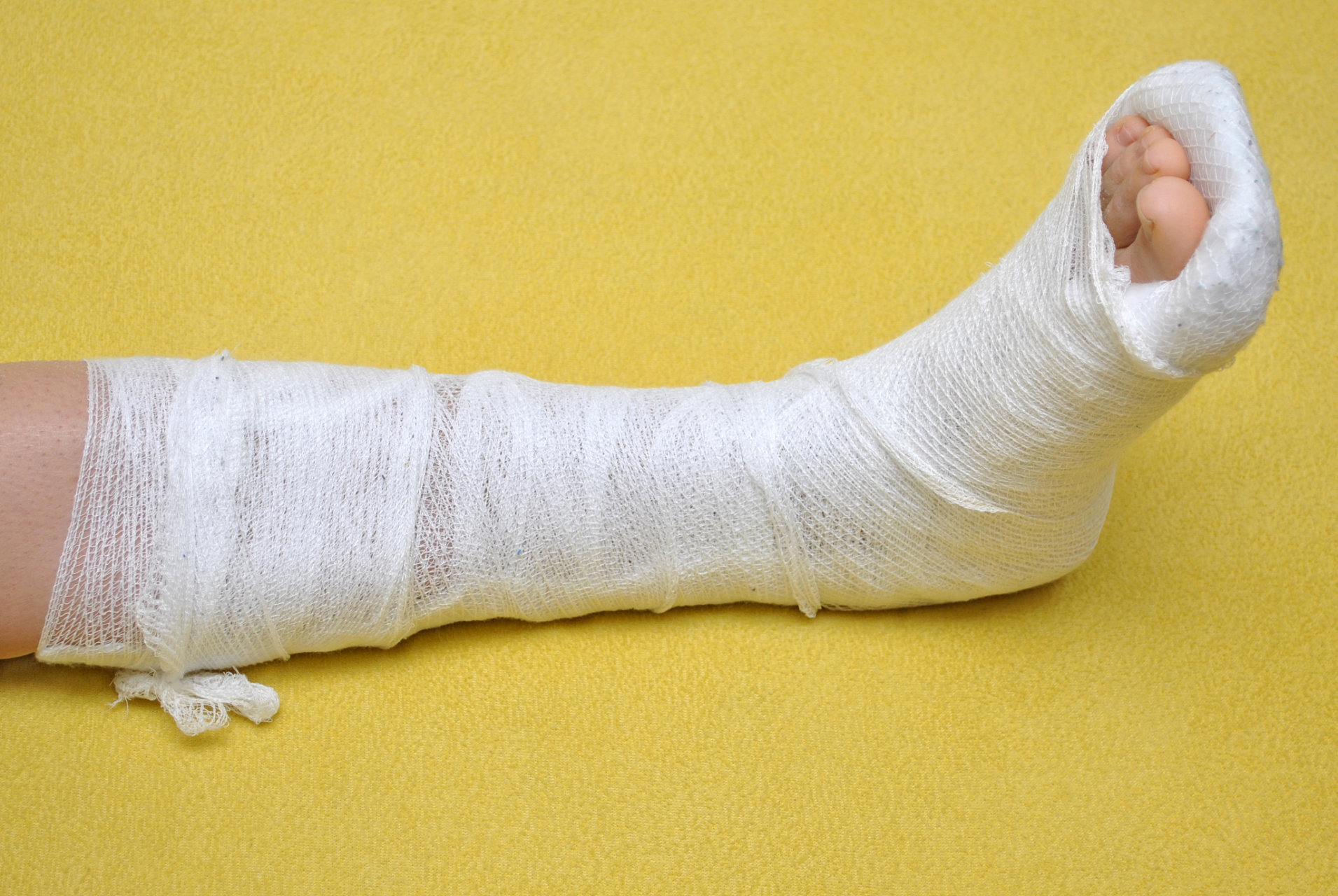 【患者自述】  我是一名22岁的男性,因为运动摔了骨折,而且还是胫骨