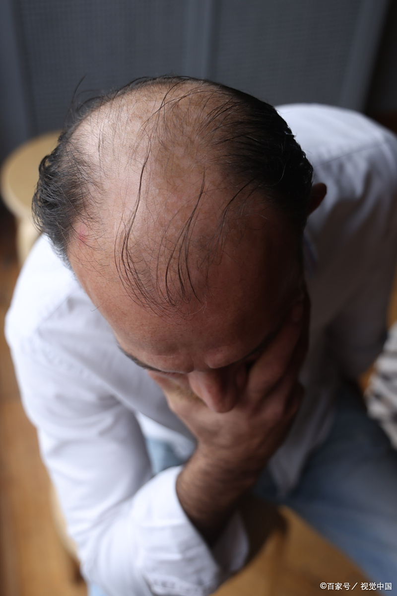 人出现秃头的因素有很多,每一种秃头的因素都不同