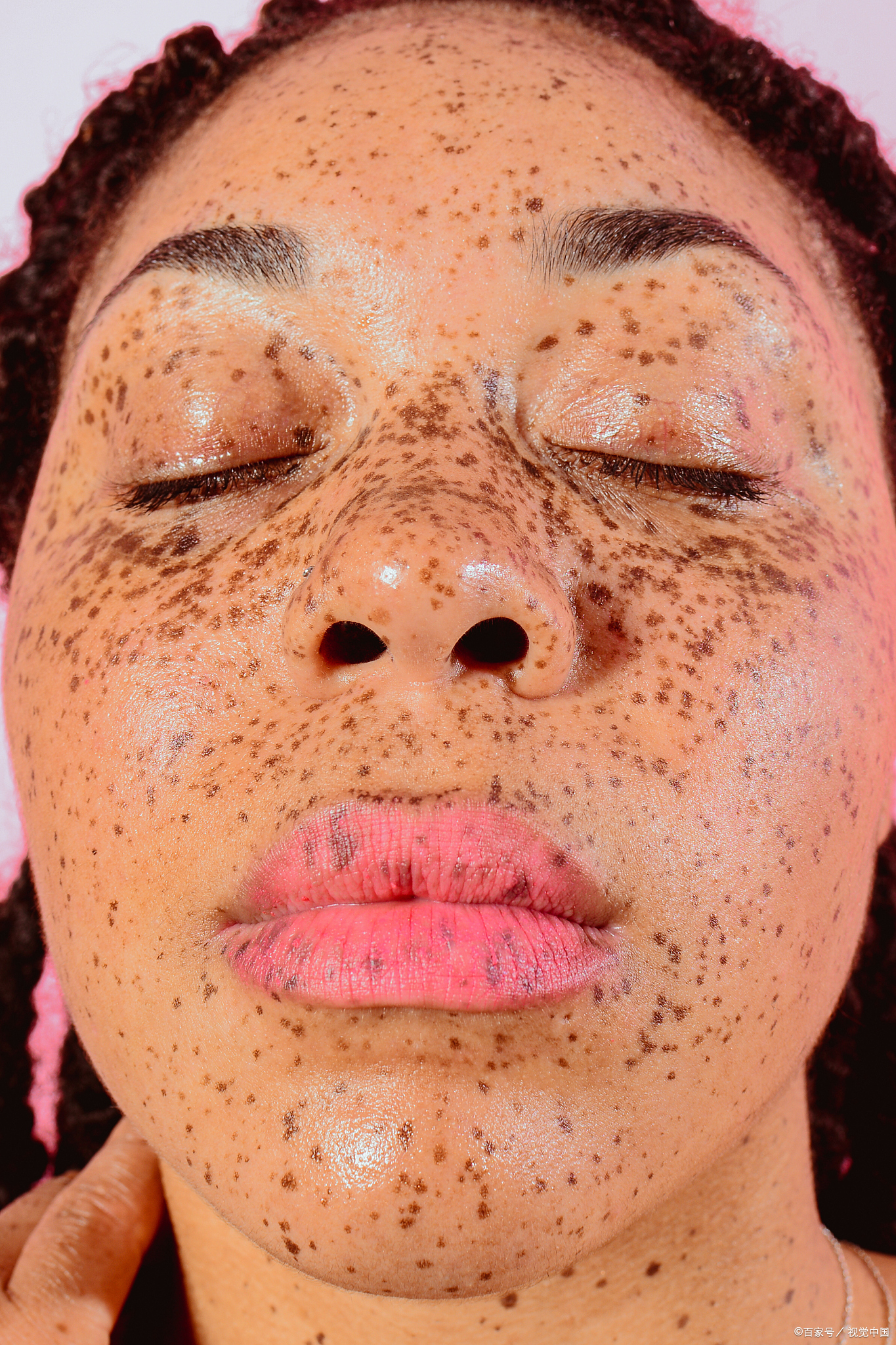 点完斑后的皮肤,如同经历了一场微型的战役,每一寸肌肤都在努力地