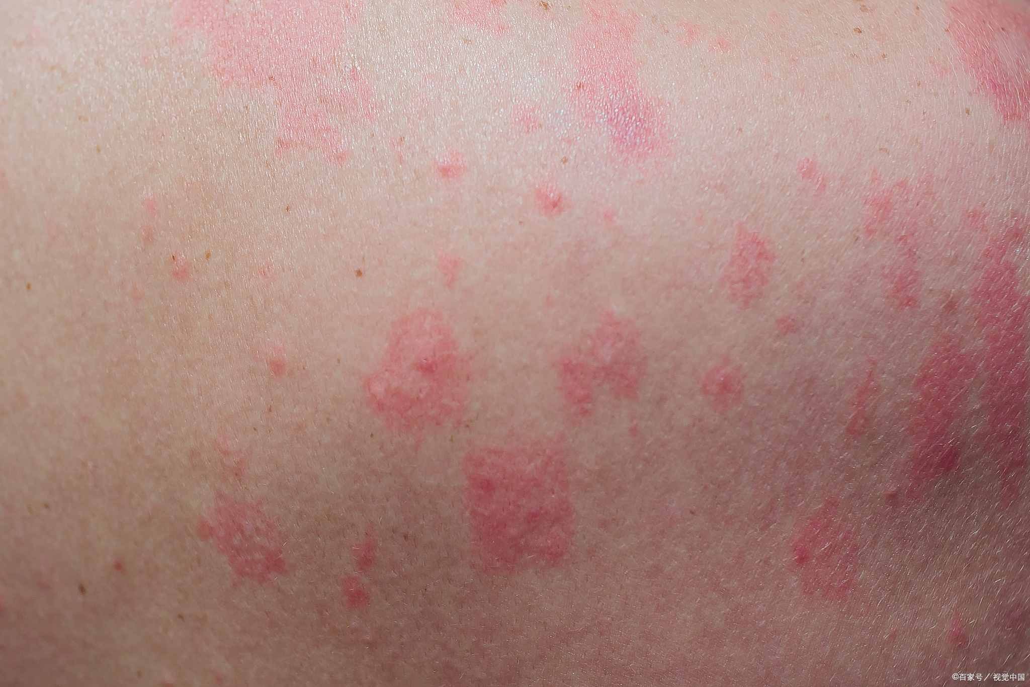 最近不少家长发现孩子皮肤冒出小红点,既担心是过敏又害怕传染性疾病