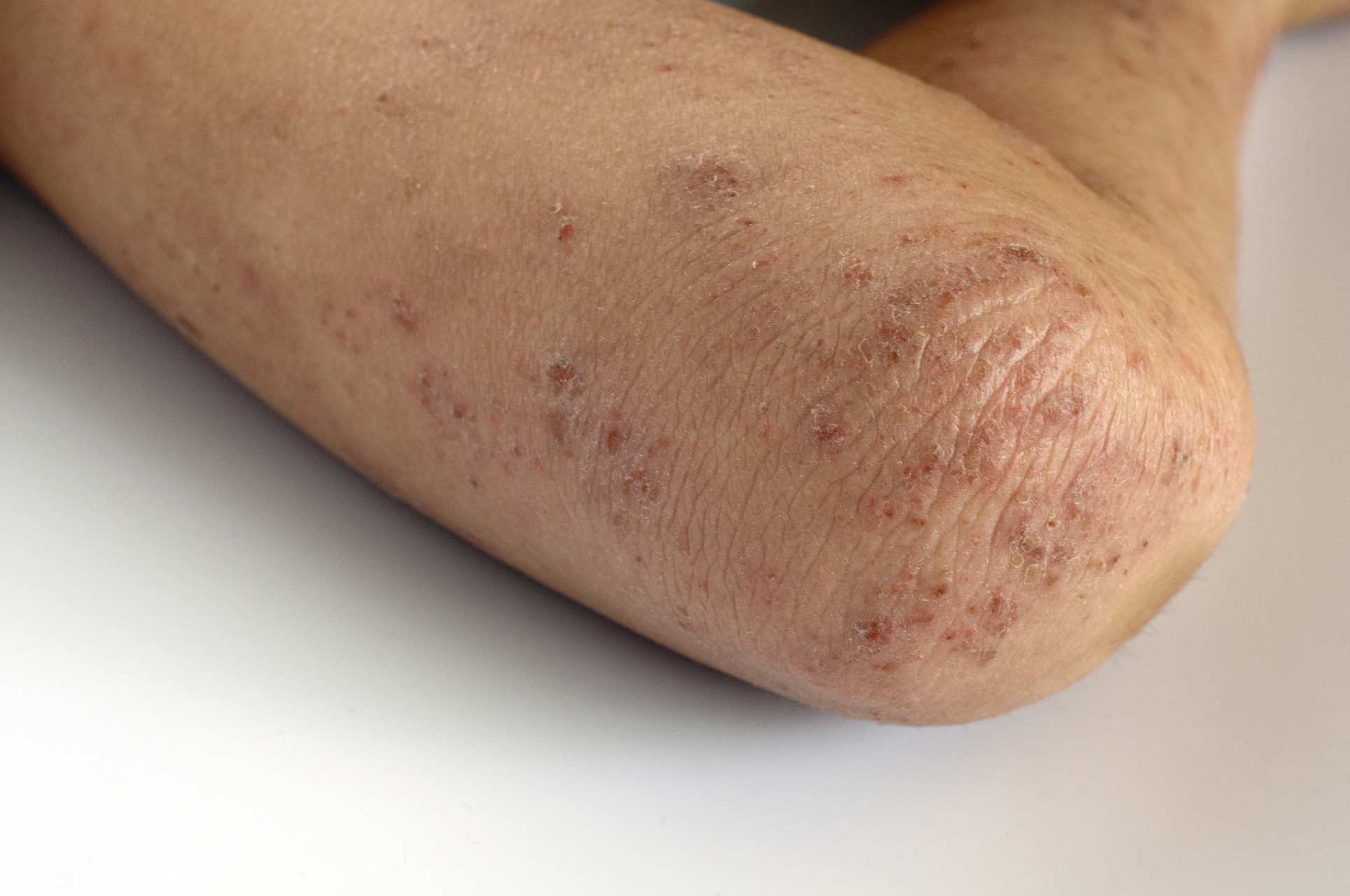 手上长了扁平疣,会不会传染给别人 ,有些人说得了扁平疣并不会传染给