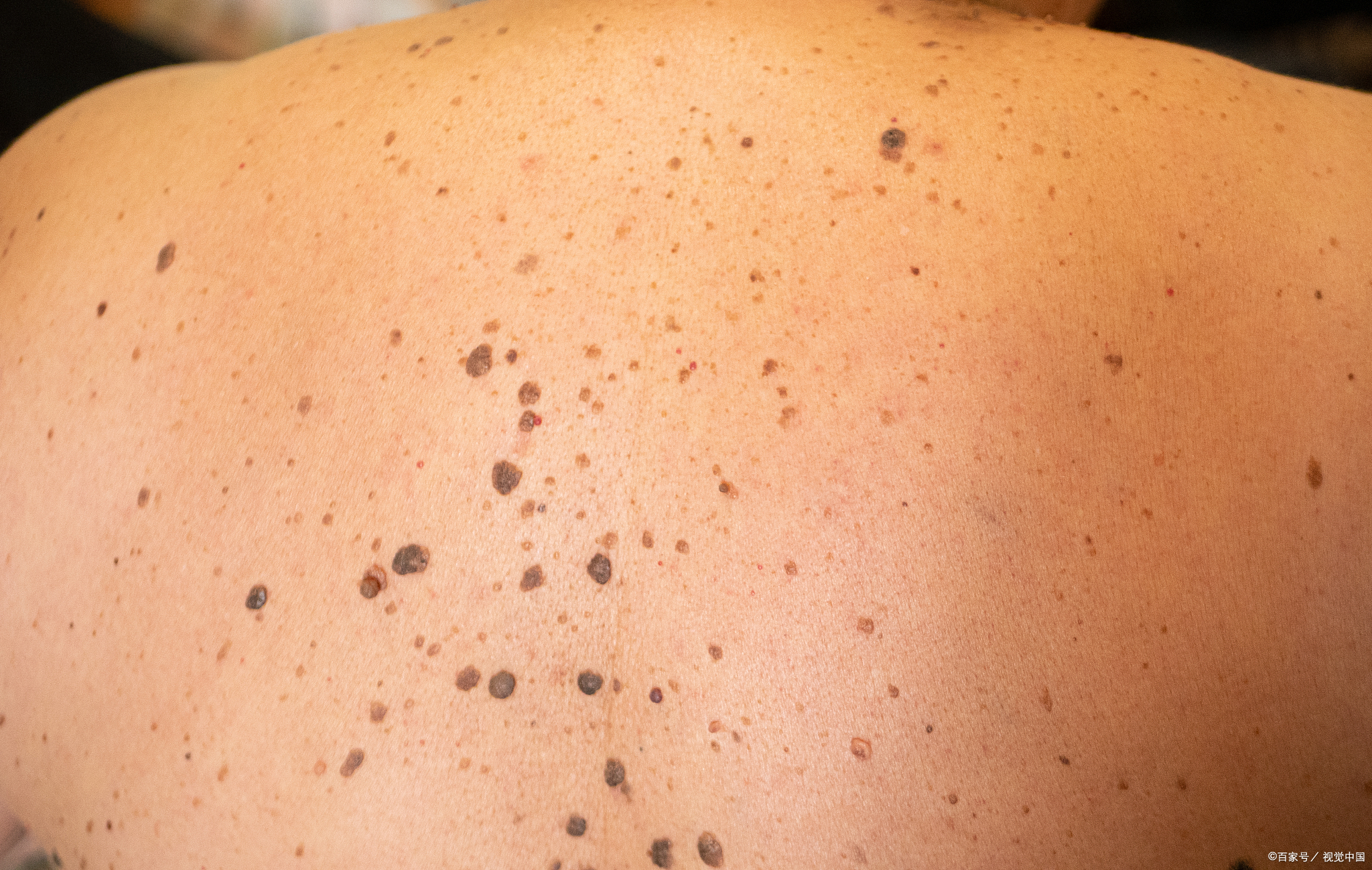 皮肤出现黑斑是怎么回事?