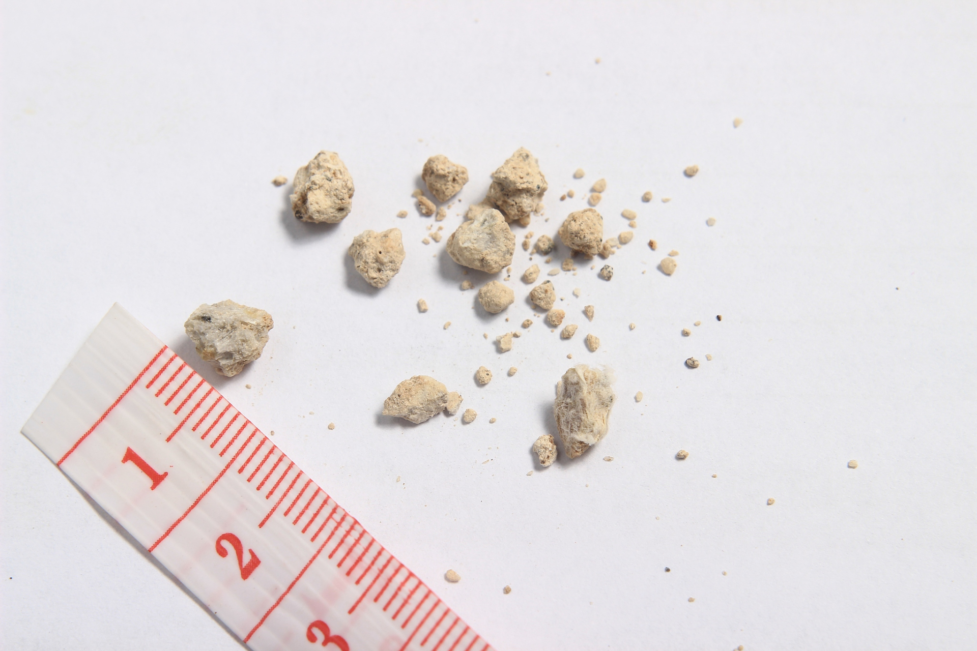 04  首先,我们要明白,不是所有的结石都需要手术.