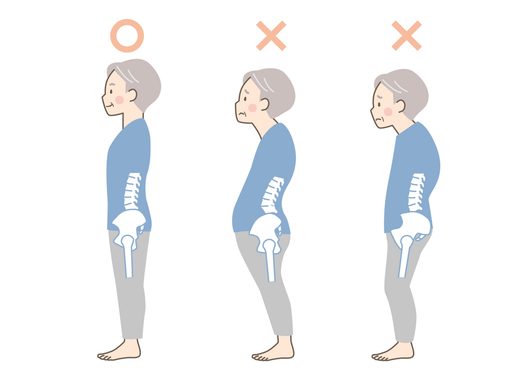 骨盆前倾是指骨盆向前倾斜的姿势,通常会导致腰部挺直或者过度弯曲