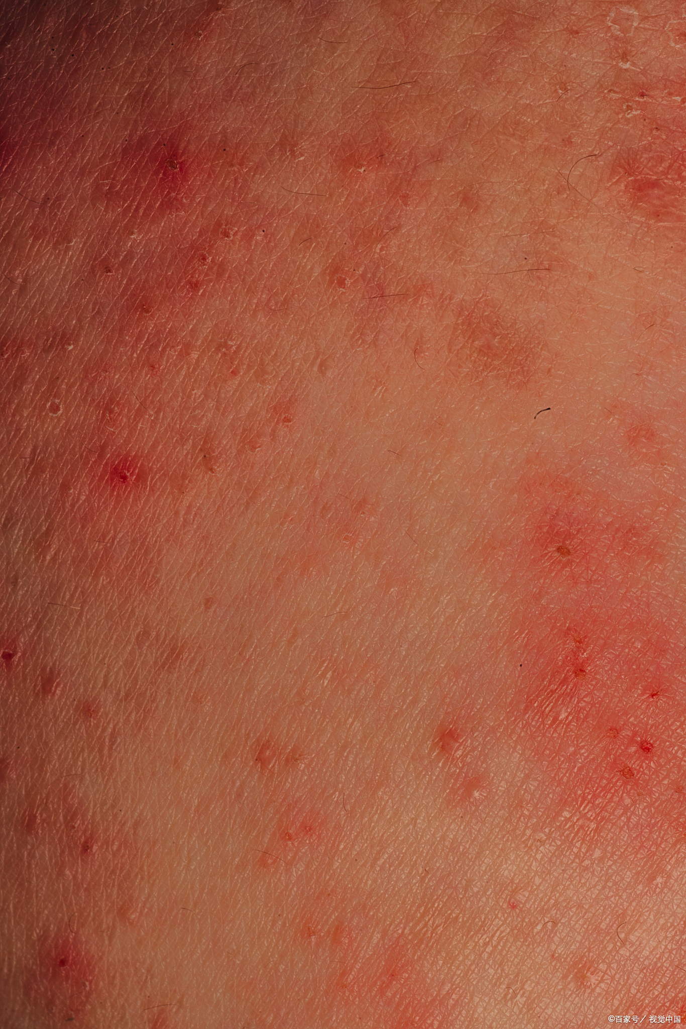 常见红疙瘩类型 过敏反应:皮肤接触花粉,尘螨等过敏原后出