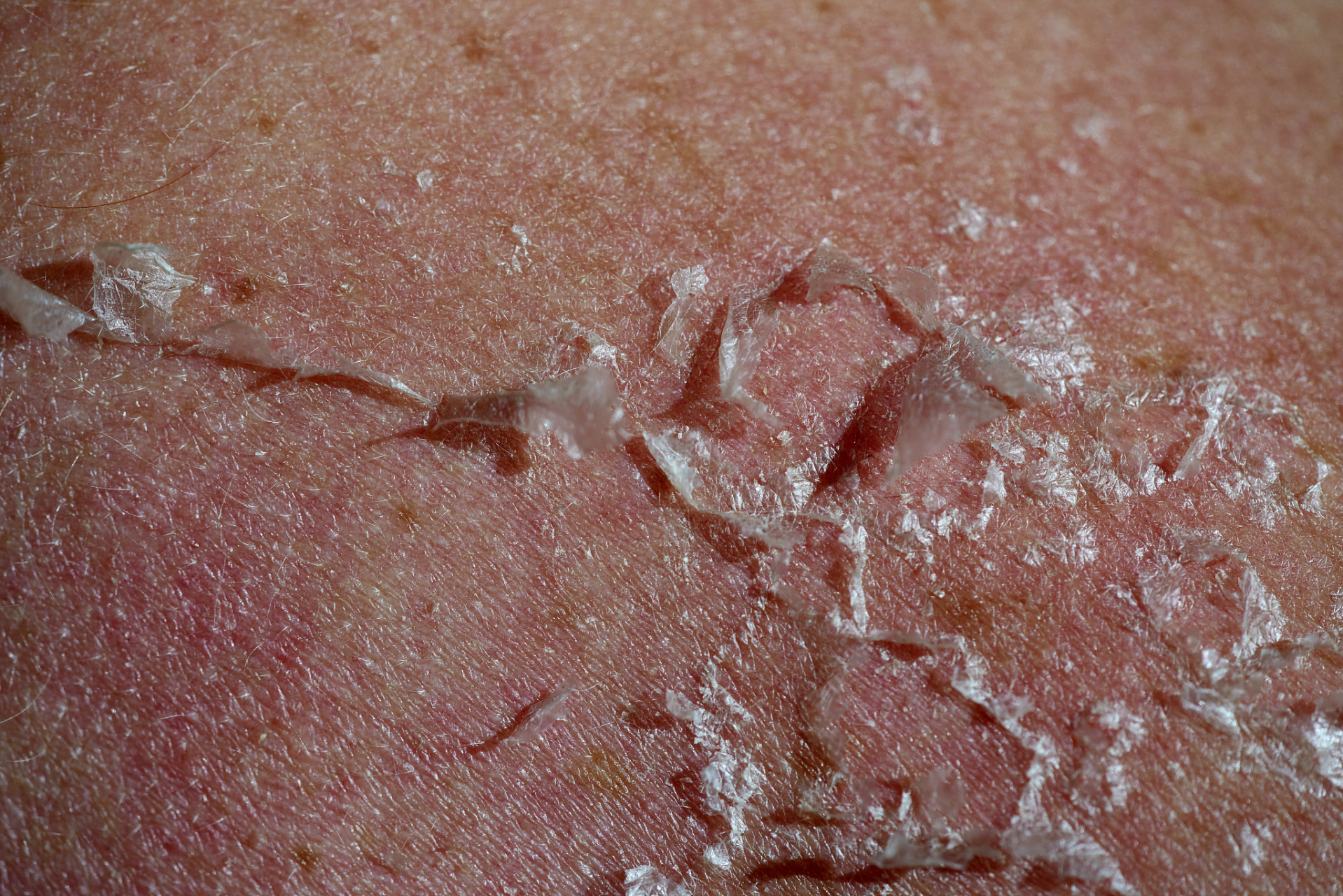 蜘蛛痣和肝掌,可能是肝脏预警  脂肪肝是肝脏最为常