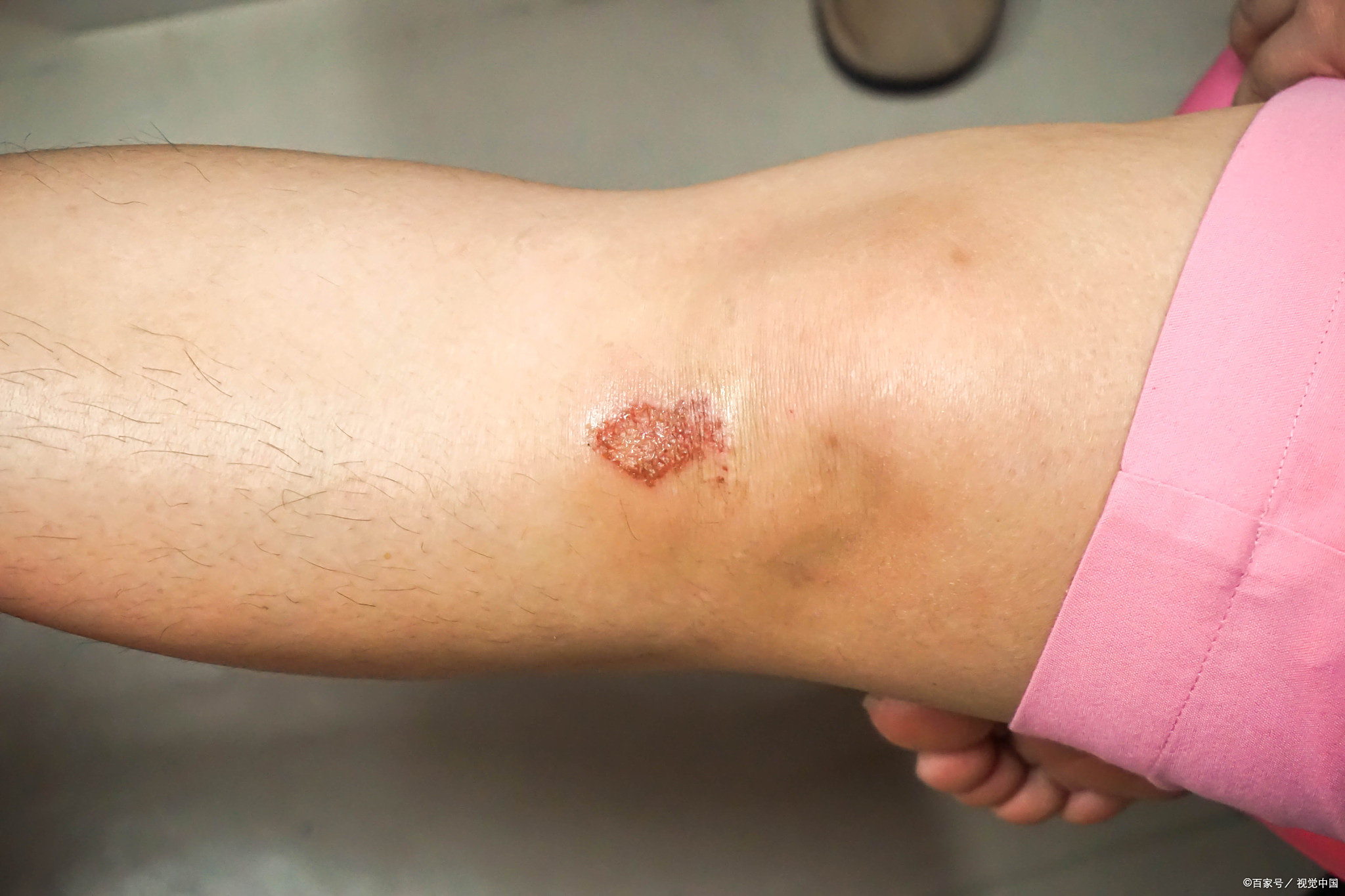 损伤处出现了红肿的现象,并有流血和组织液渗出,于是来我院就诊