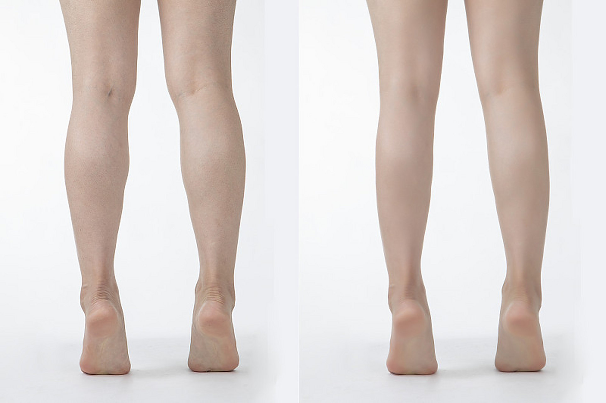 近年来,吸脂瘦小腿手术逐渐受到关注,但很多人对其效果心存疑虑.