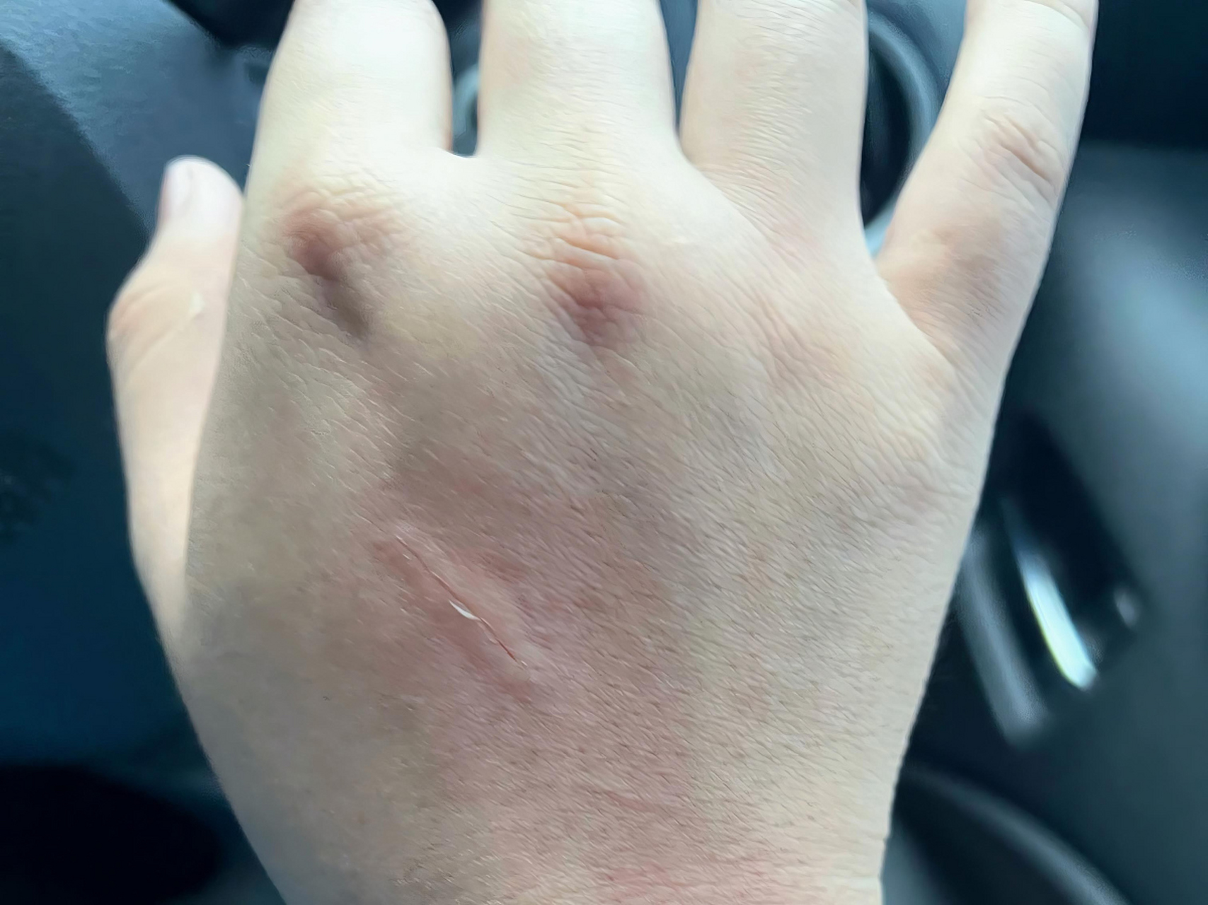 被猫咪抓伤,切记别轻视05.