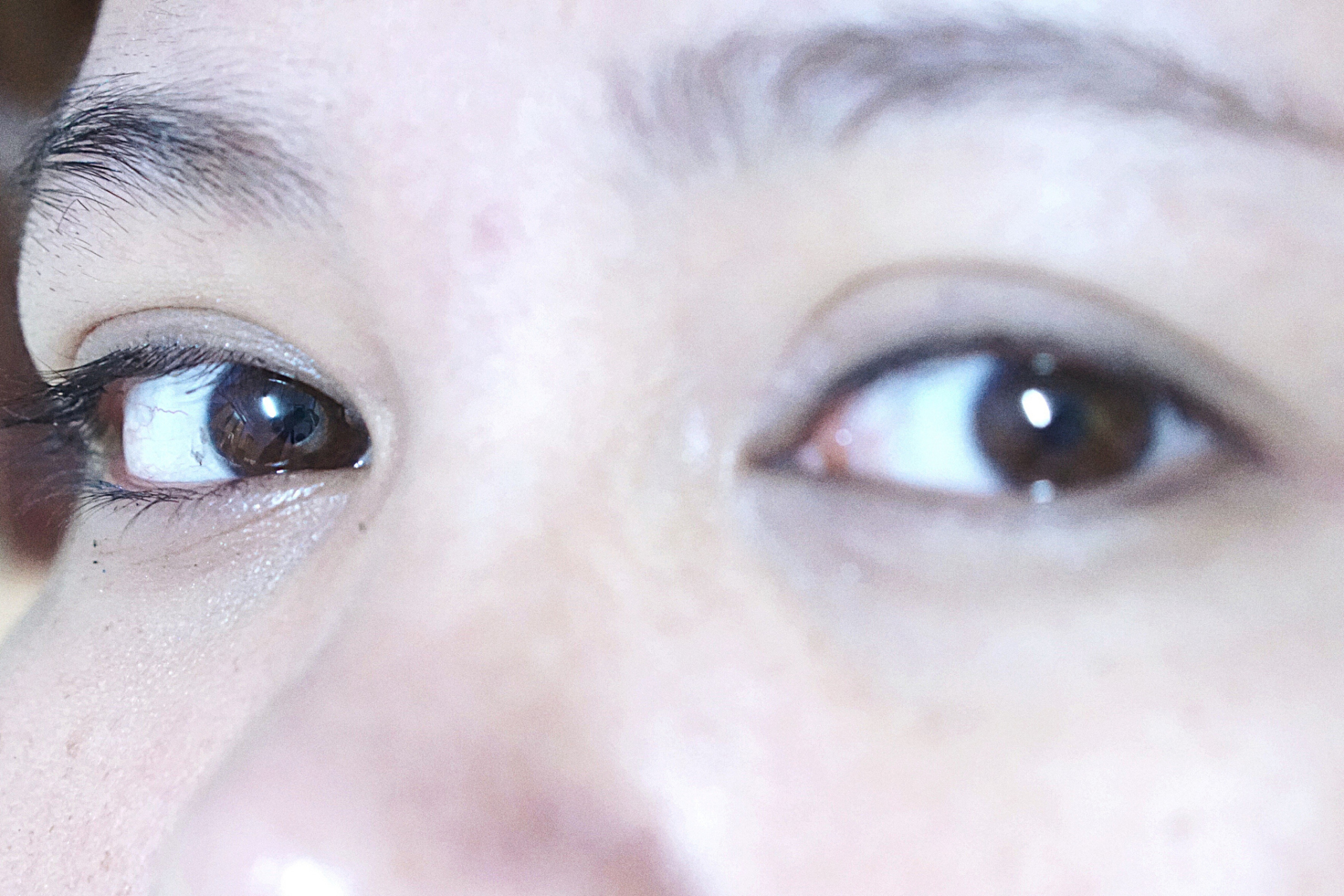 脸上的烫伤疤有黑印怎么去除  疤痕是皮肤组织受到损