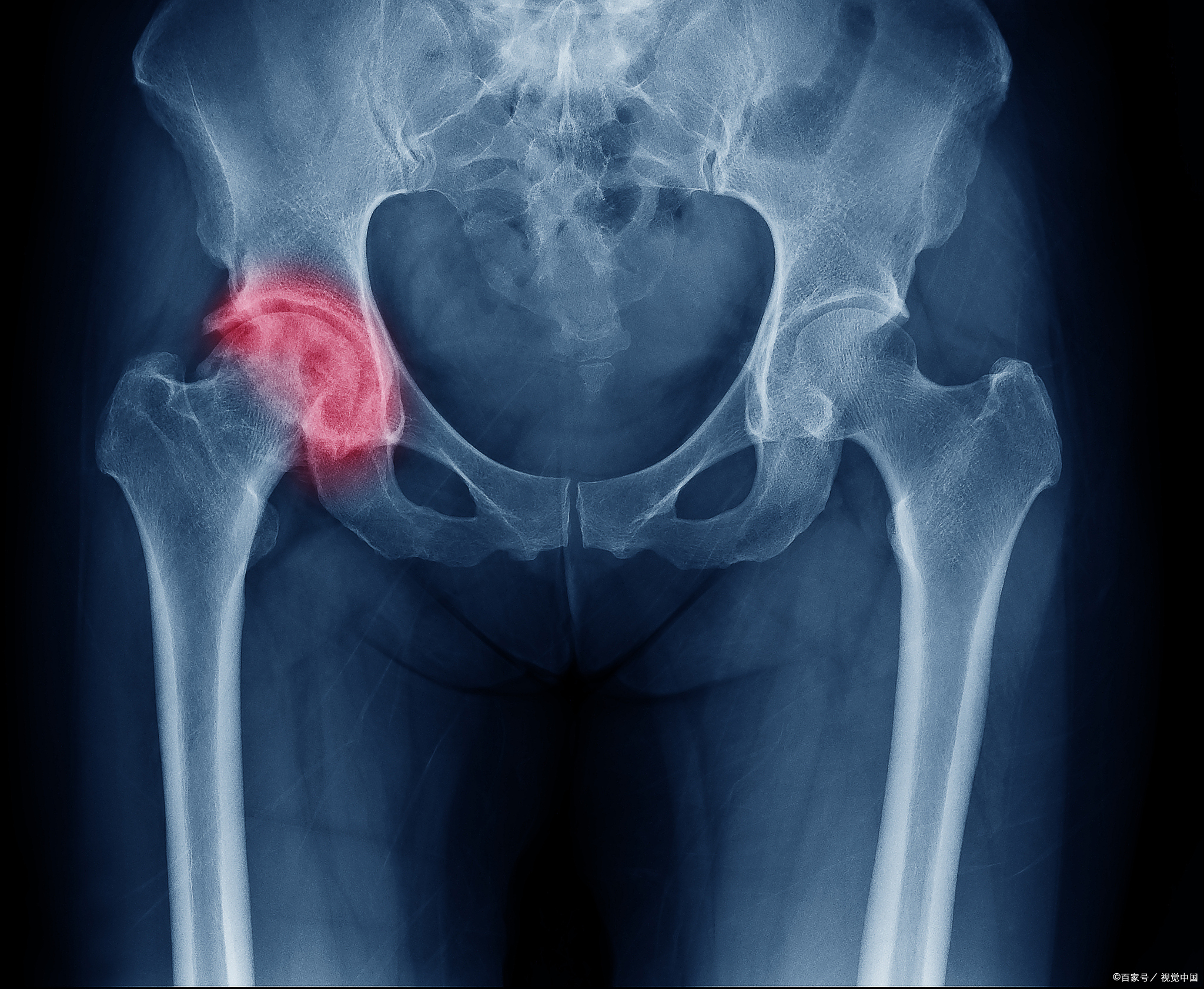 这种被称为"不死的癌症"的股骨头坏死,其实有这些