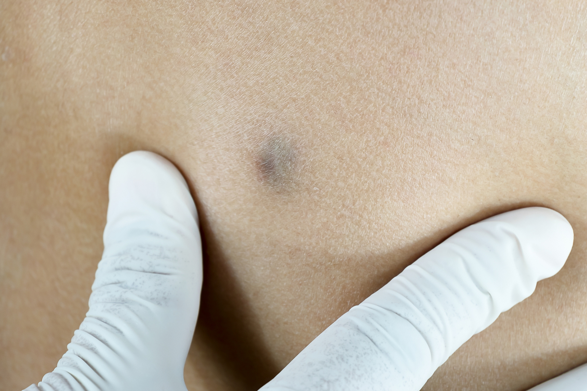 那么皮脂腺囊肿该如何治疗呢 你是否曾经因为皮脂腺囊肿而烦恼不已?这