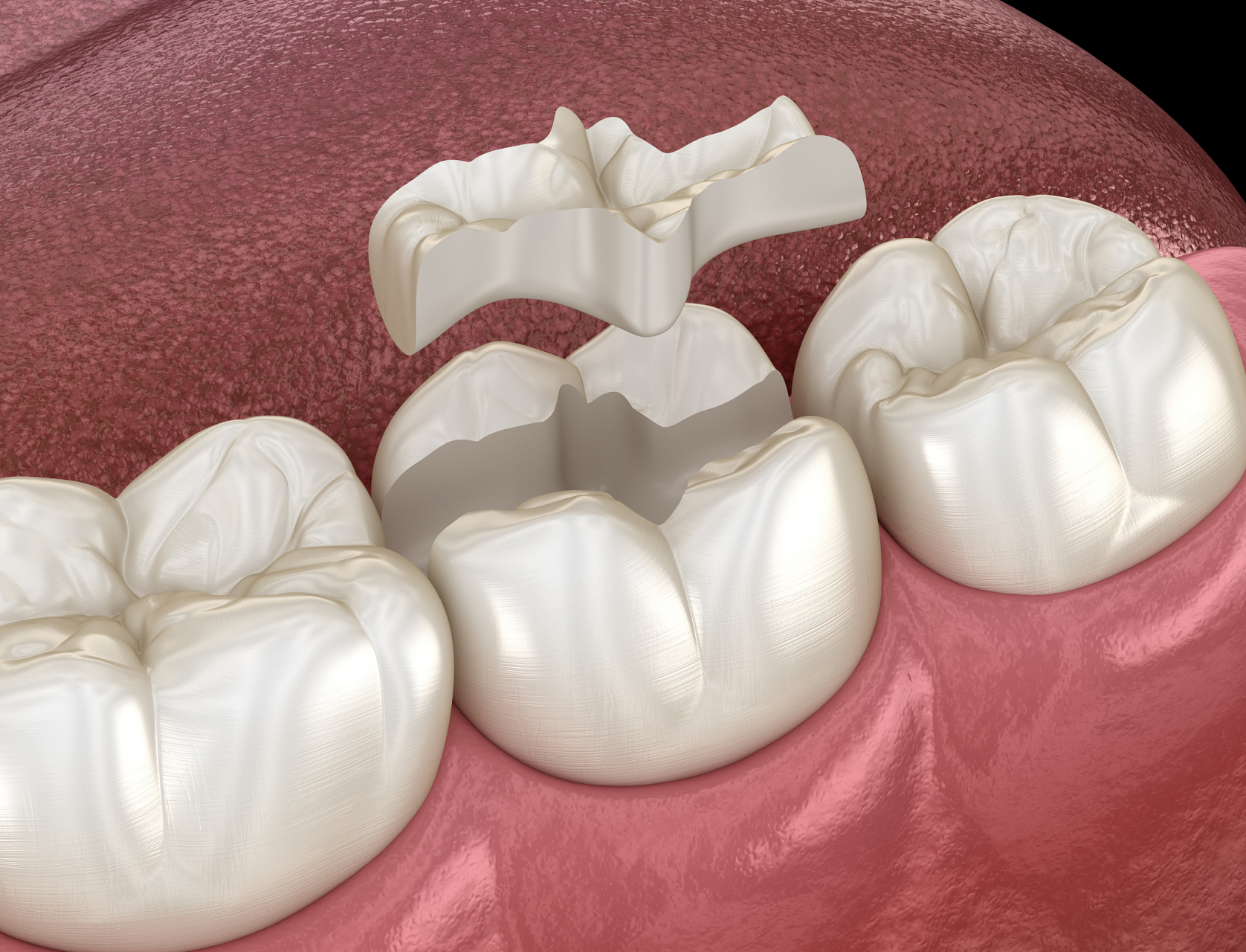 嵌体(inlay)是一种用于修复牙齿的口腔修复物,通常由金属,陶瓷或