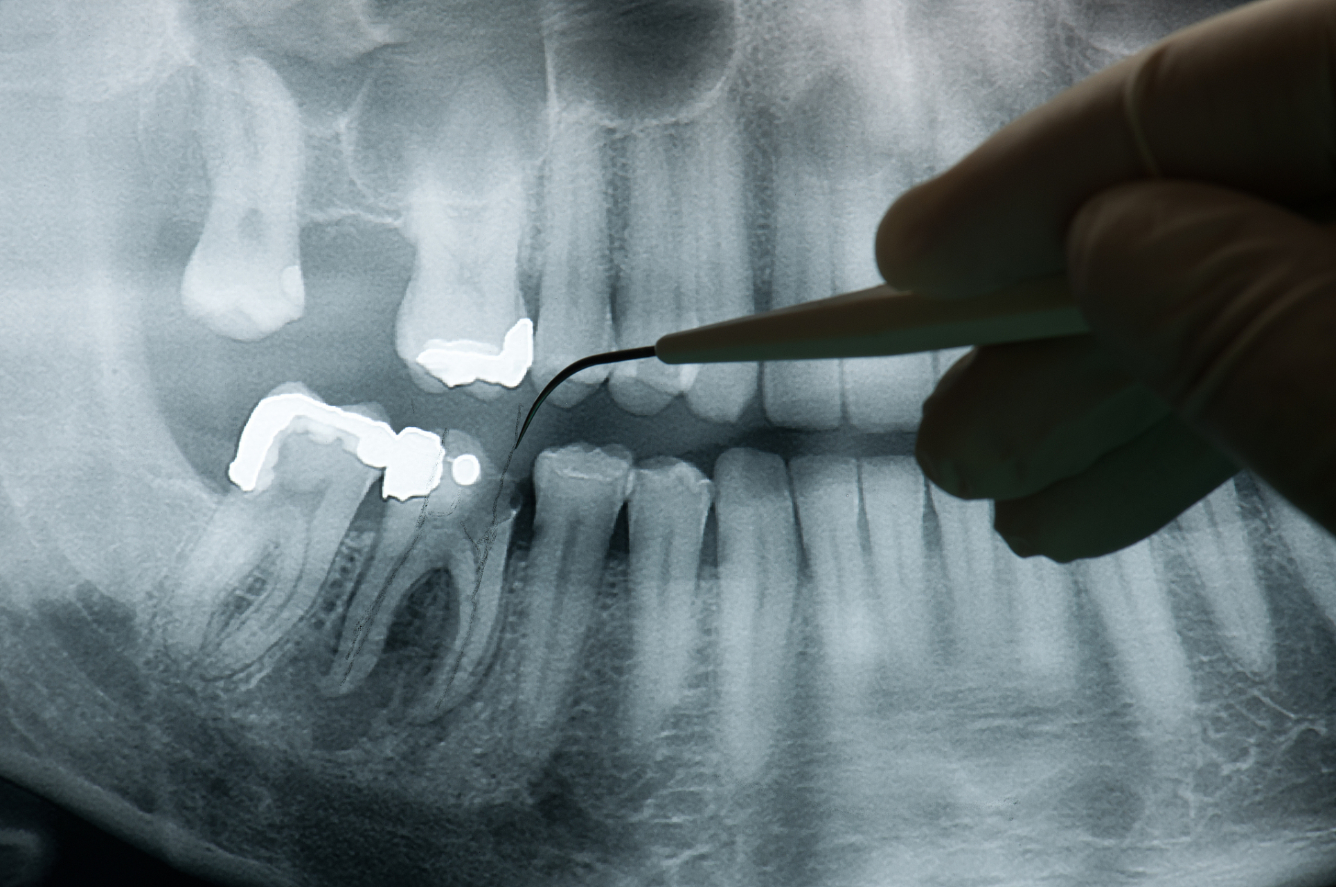73根管治疗常见的12个问