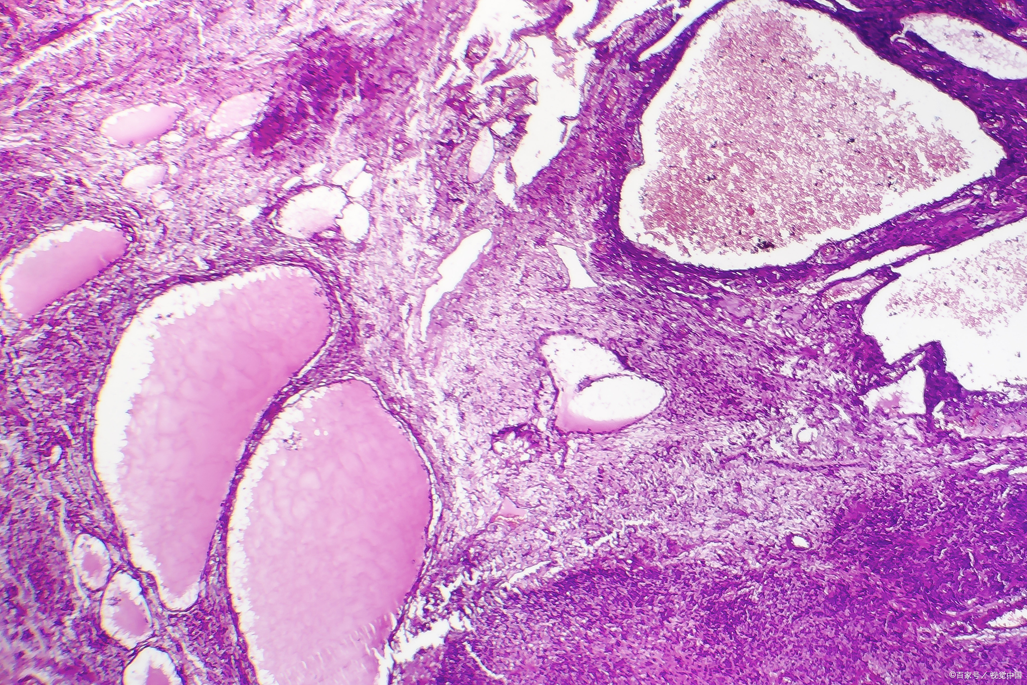 同一张病理切片,不同医.@乳甲外科曹卫刚医生的动态