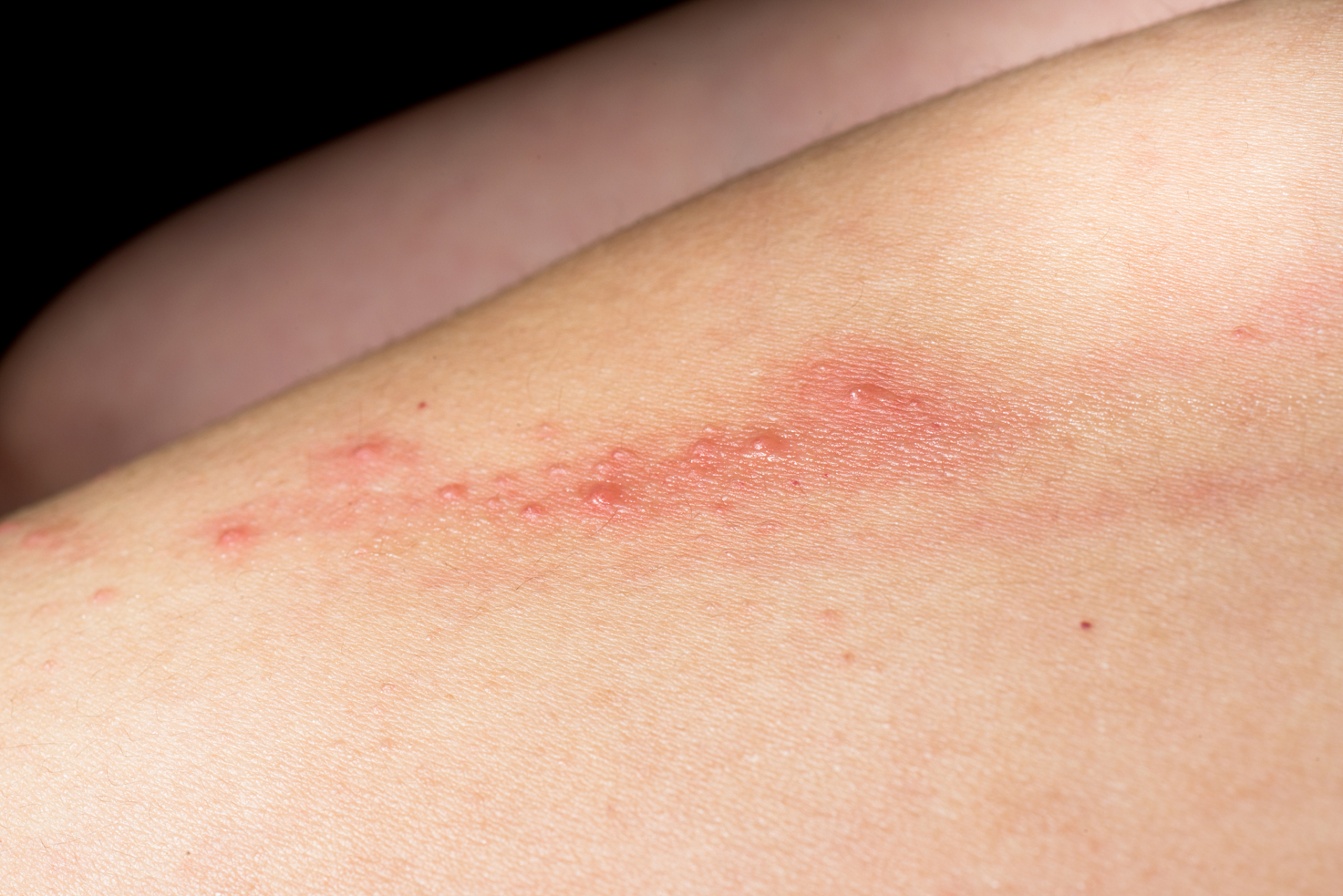 惠州皮肤科医院# 皮炎是个非常广义的概念,所有的皮肤炎症反应都澄