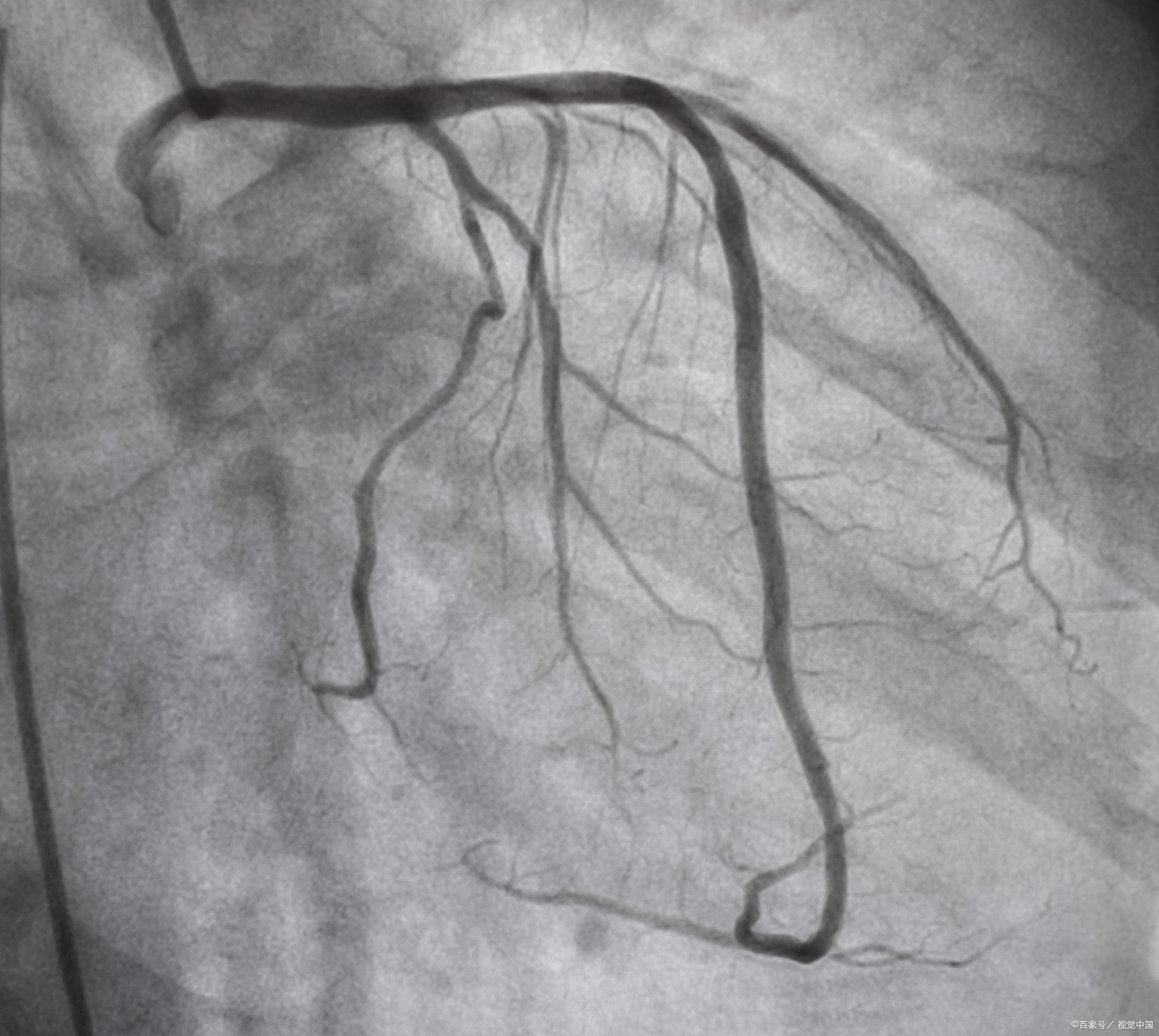 冠状动脉造影图详细图图片