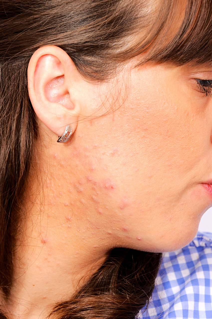 想要改善痘痘脸可以从以下这些细节出发.