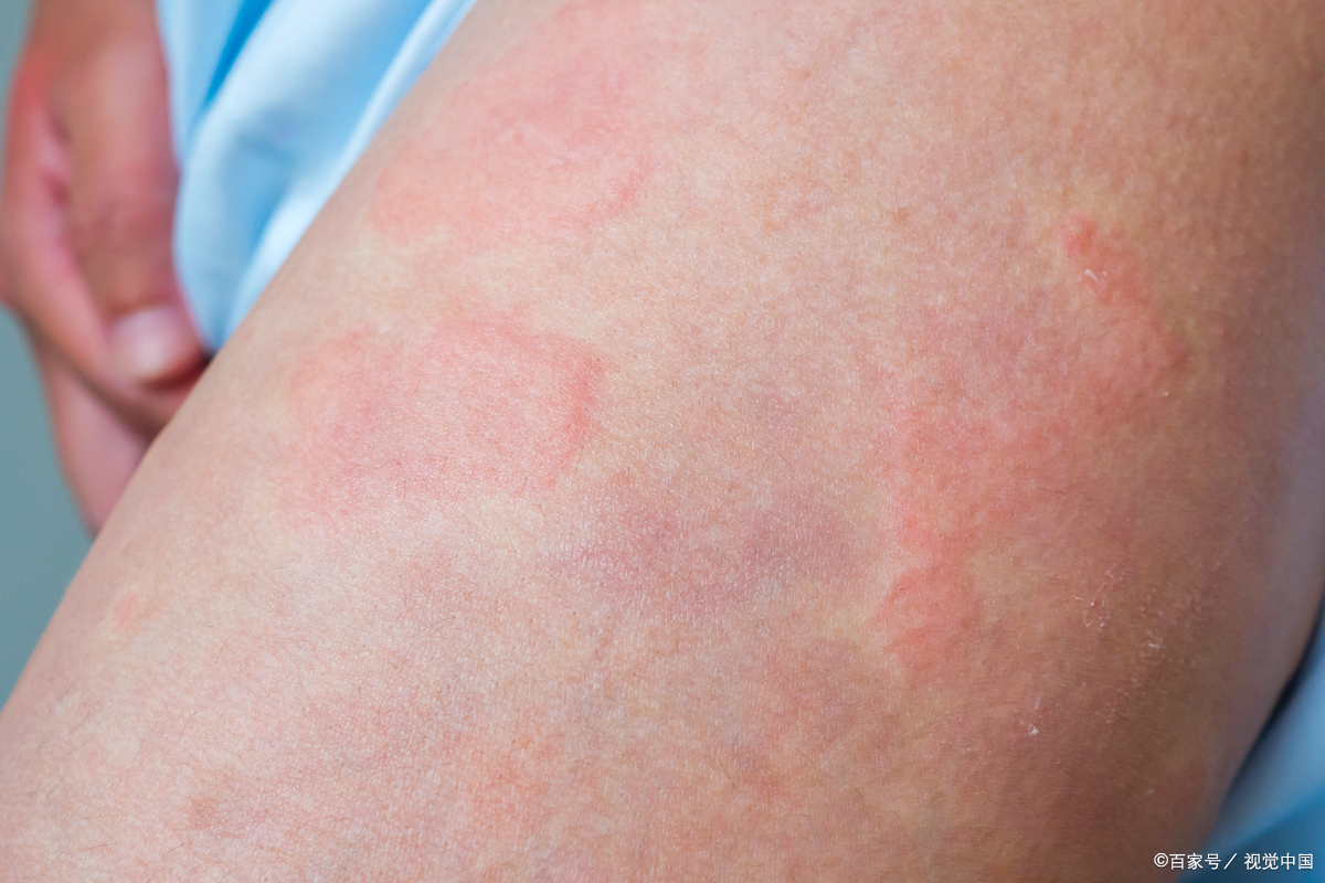 荨麻疹是一种常见的皮肤疾病,发作时瘙痒难耐,严重影响生活质量
