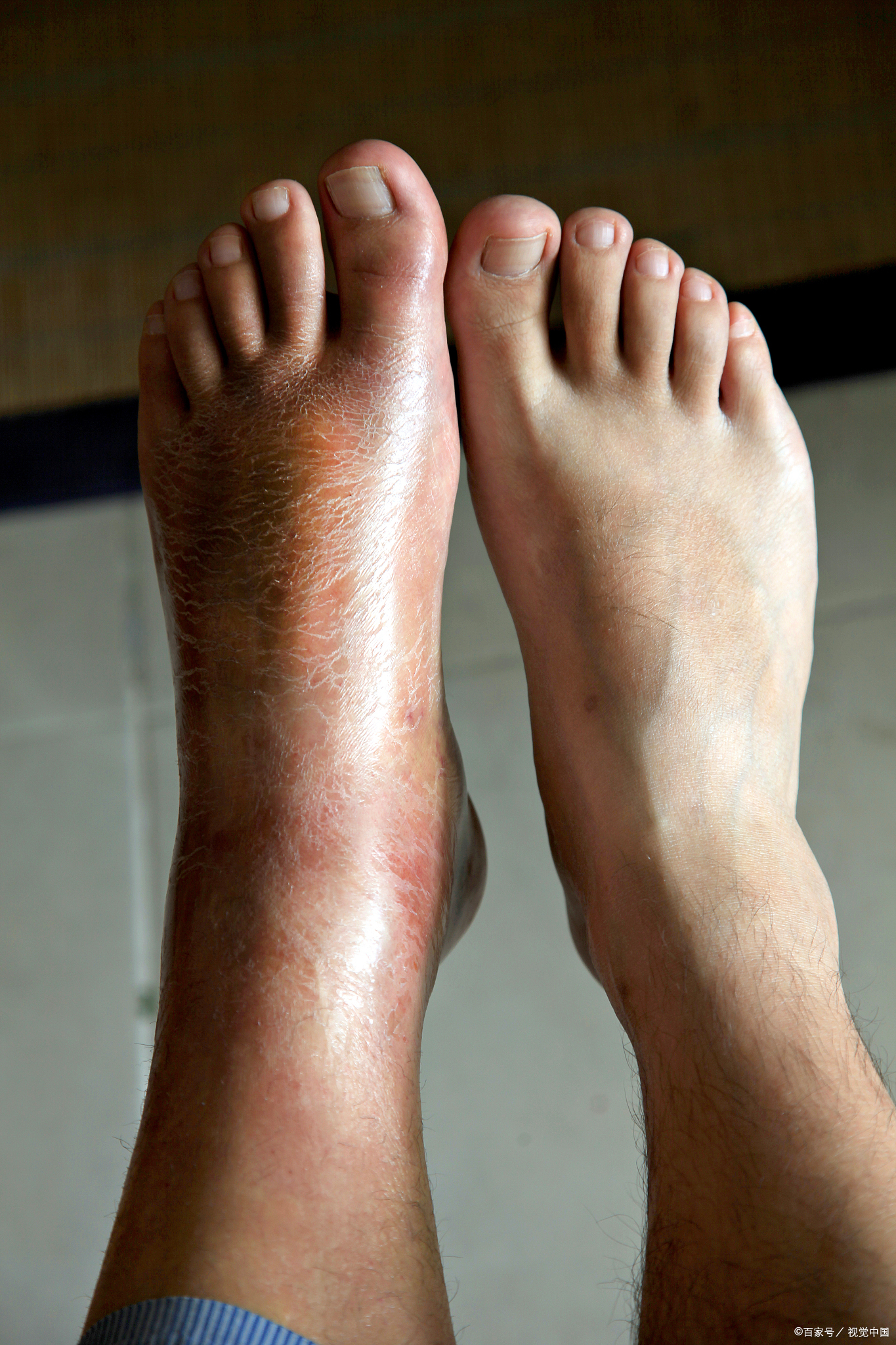 你对下肢水肿这种情况了解吗?