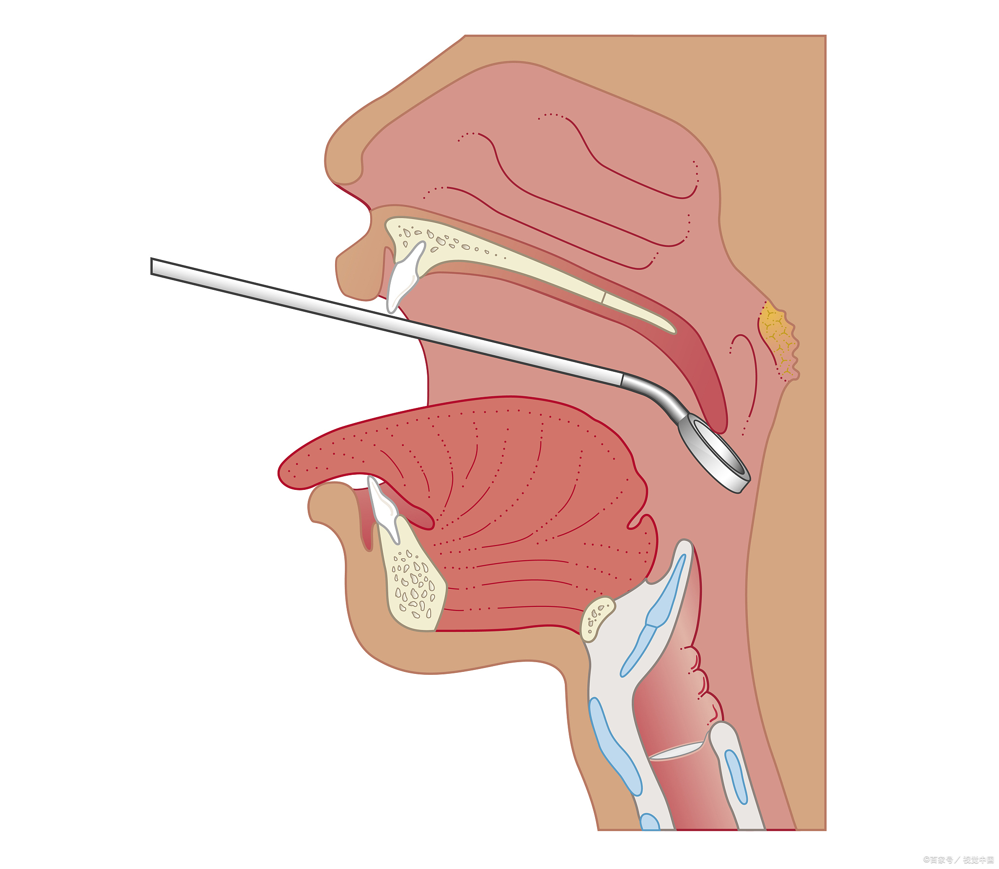 棉签戳喉咙图片图片