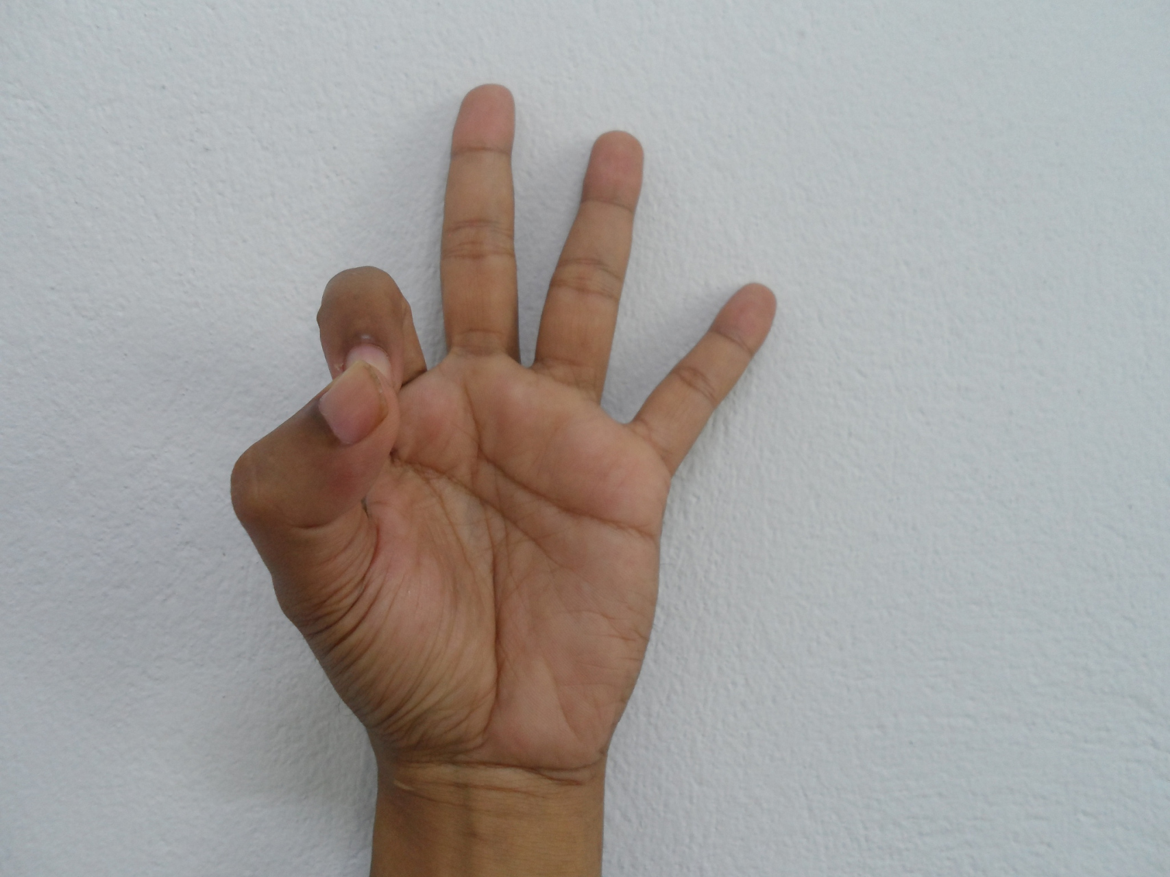 手部神经损伤:爪形手,猿手,垂腕 桡神经:主要支配虎口背侧皮肤感觉