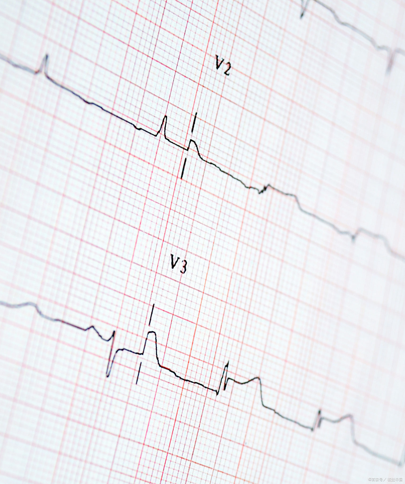 房室传导阻滞:心电图有何信号?