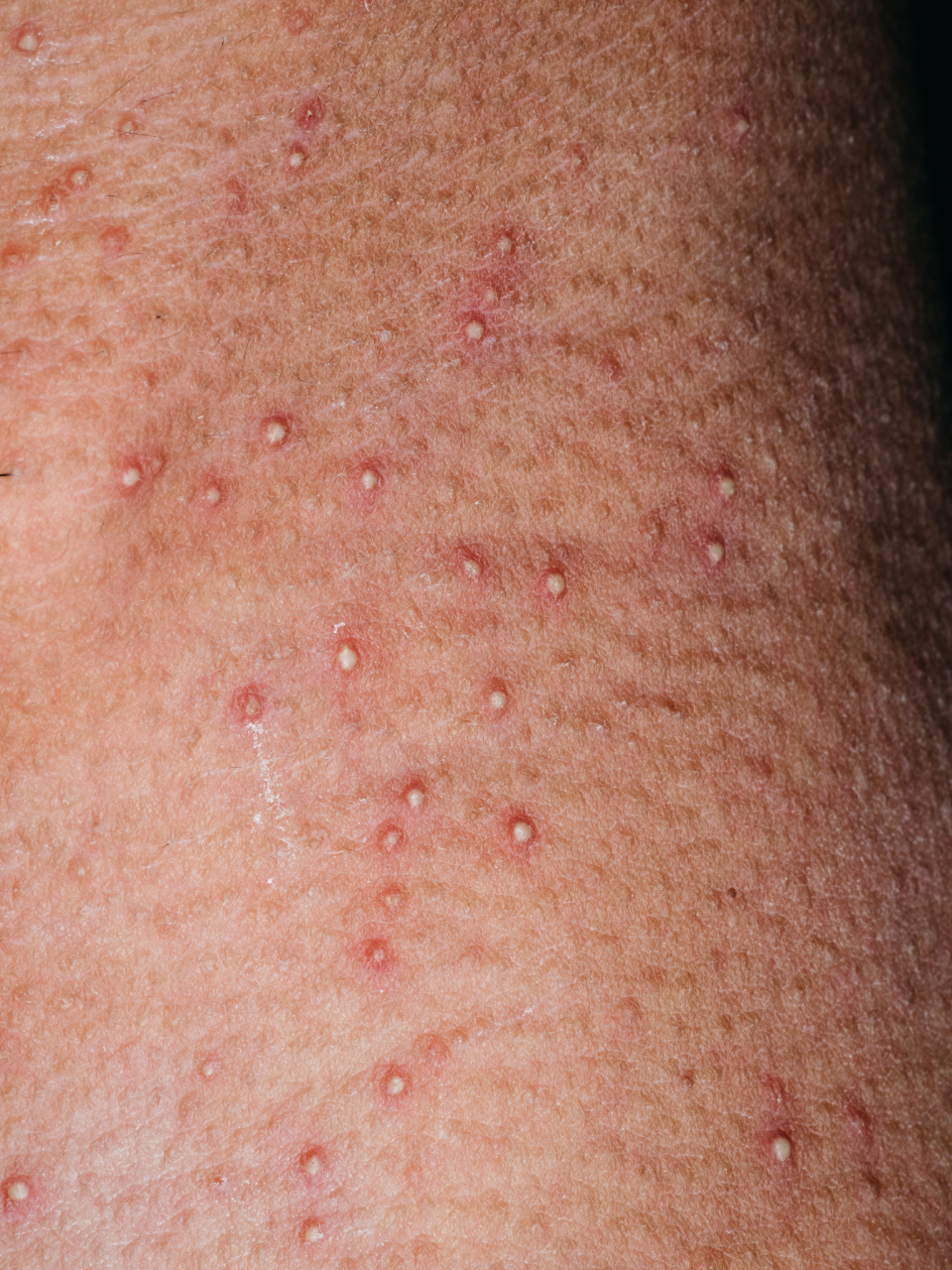 5%,通常发生在头面部,颈部,躯干四肢等暴露部位.