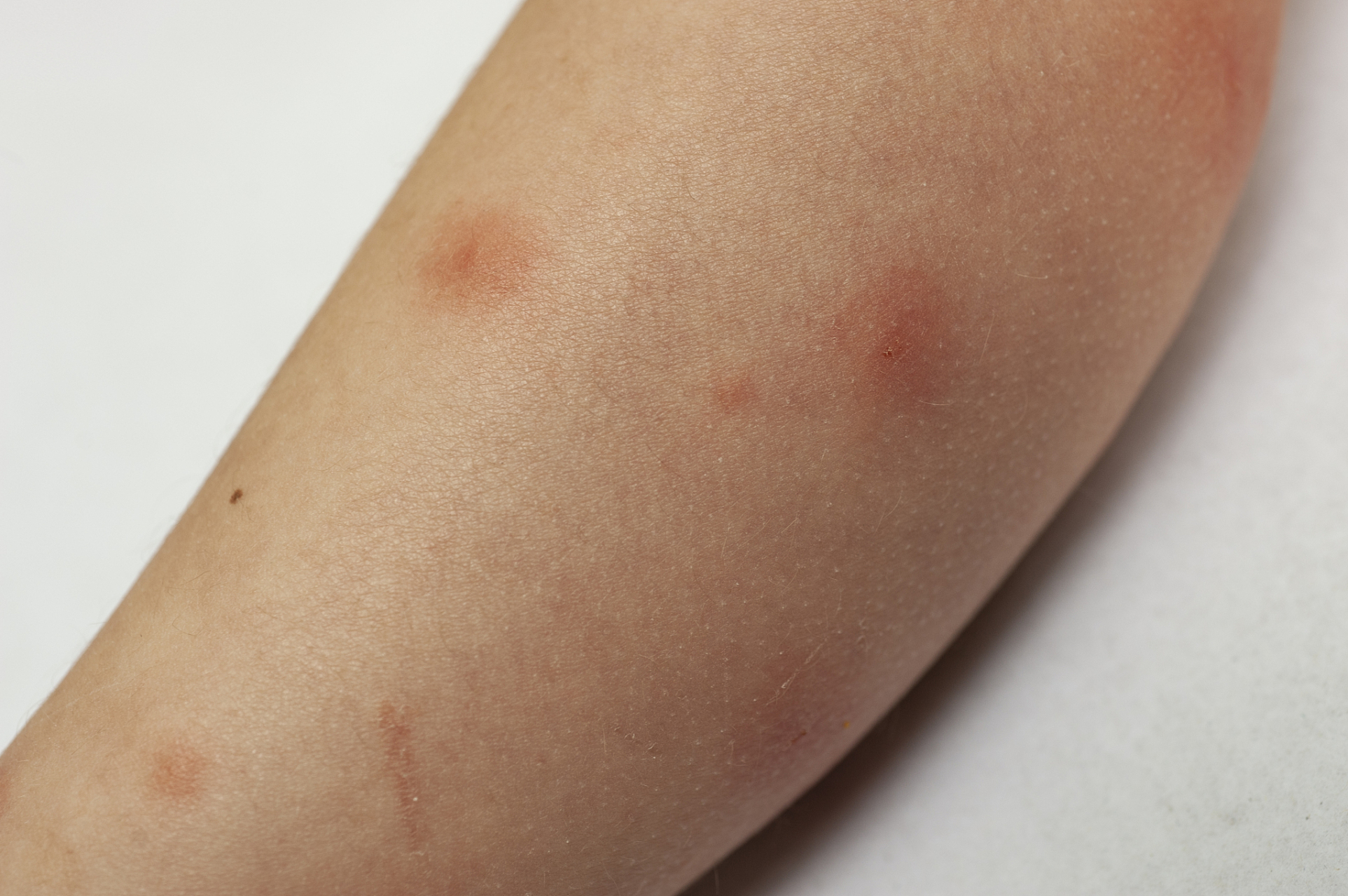 皮肤瘙痒警惕9种疾病图片