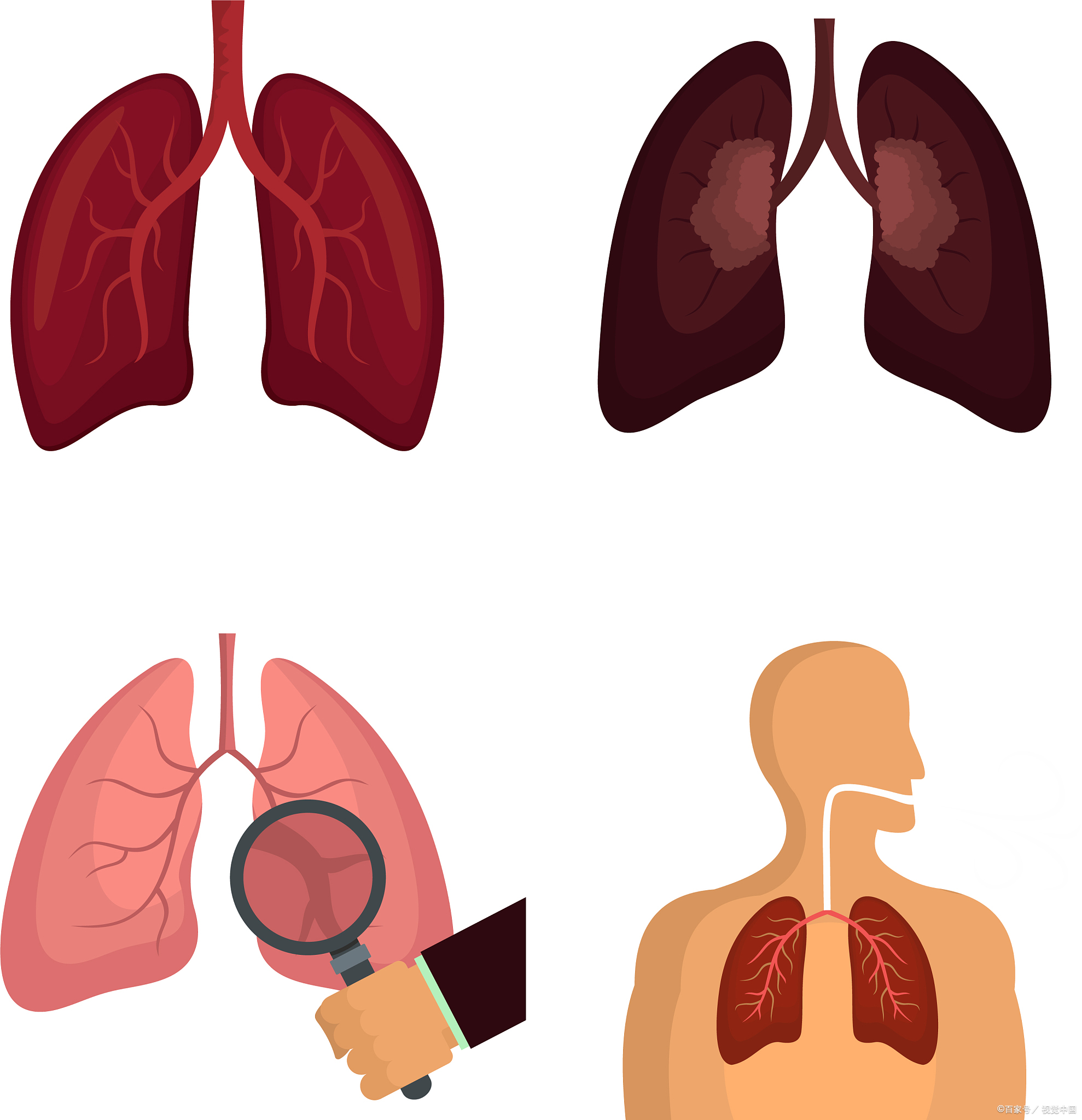 4种人最容易得肺结节 3大类食物尽量多吃 消瘀散结养肺润肺  1.