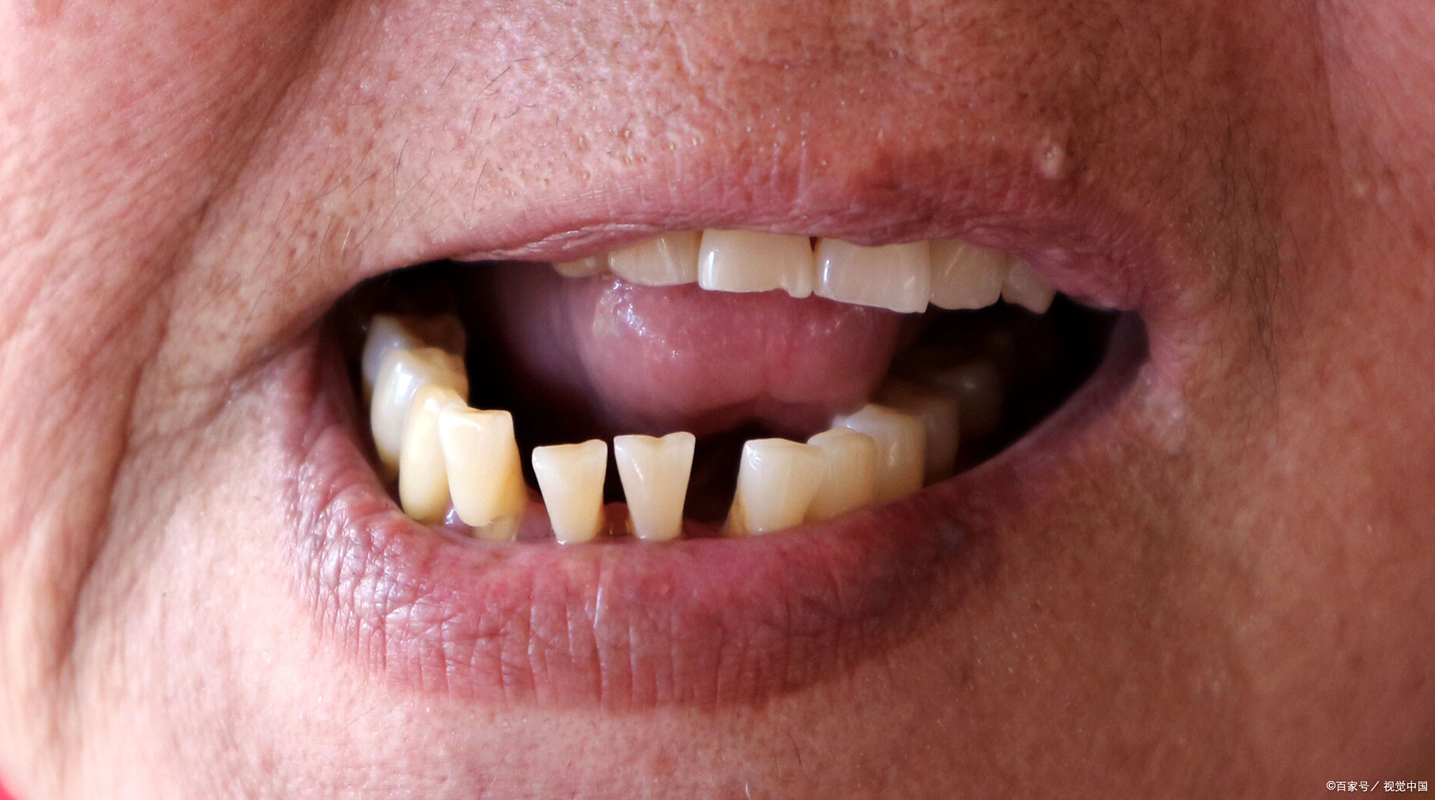 牙齿缝隙虽常见,但并非无解