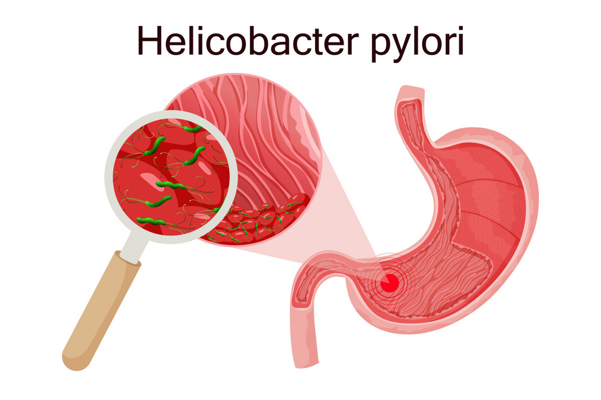幽门梗阻的症状可能因患者个人差异而有所不同,但通常包括: 1.