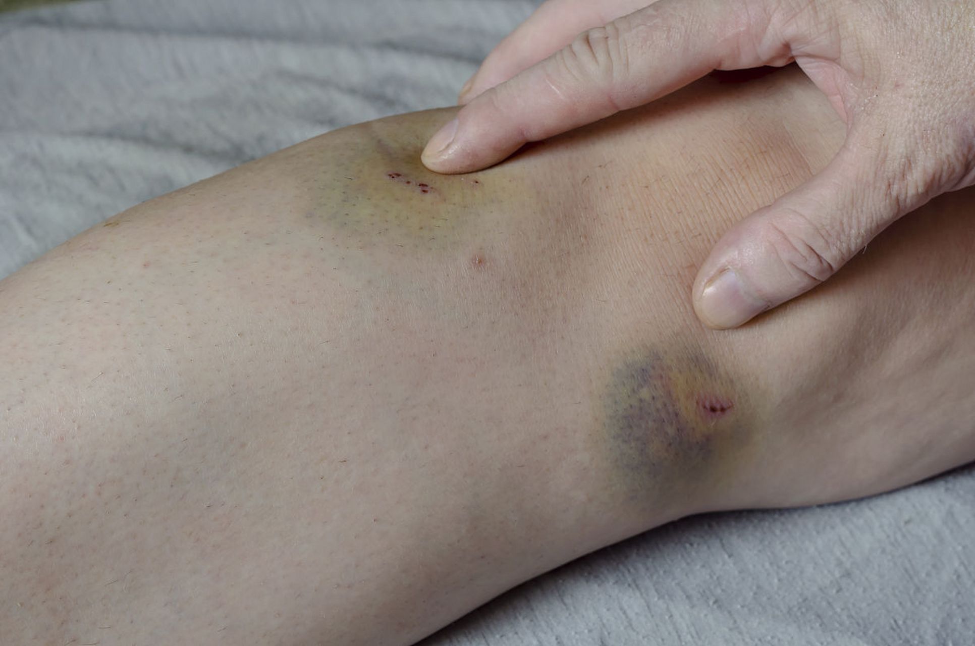 虽然淤青的完全消除需要时间,但以下方法可以帮助加速淤青的吸收和