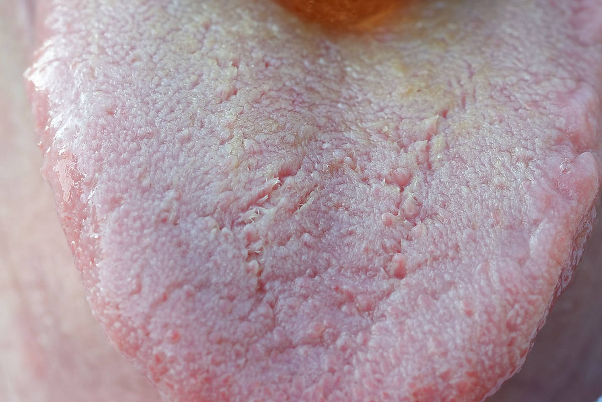 便宜!舌苔厚白最快消除方法"送子天下"-第1张图片-普贤博客