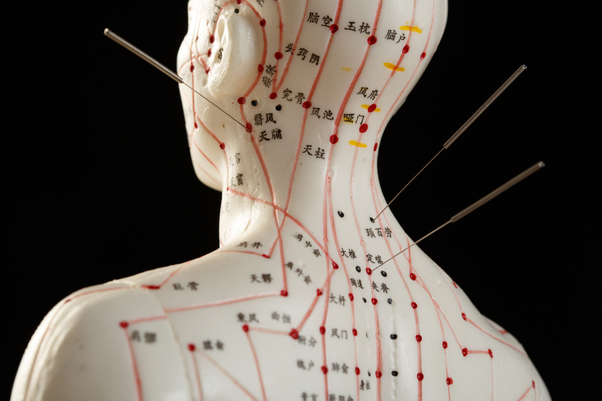 【体针】  主穴:分2组  1,足三里,阳陵泉,三阴交;  2,曲池.